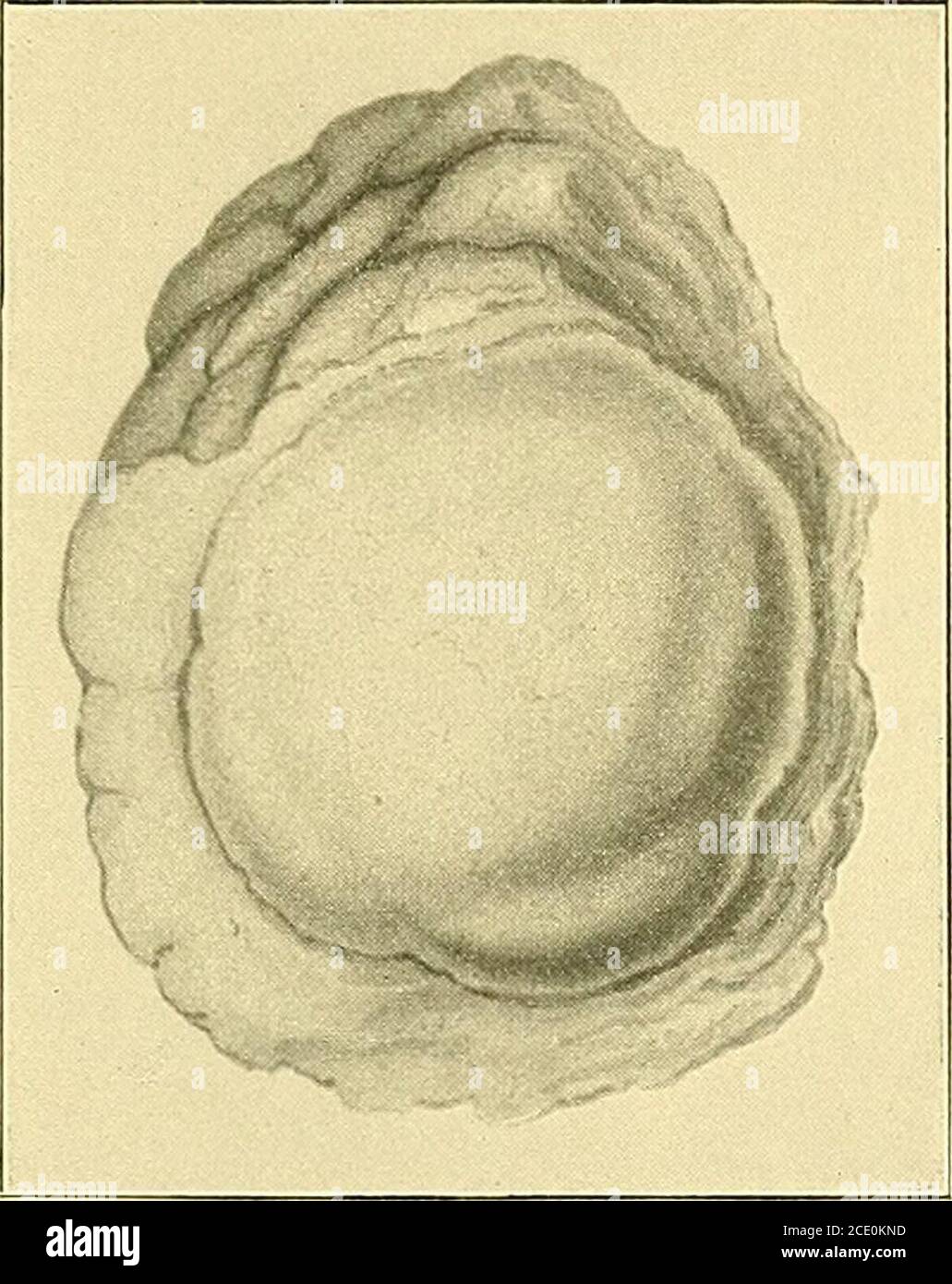 . Some points in the surgery of the brain and its membranes . Fig. 42.—Spreading septic softening of the right frontal lobe. (Hooper, 1826.) Lebert gives a good illustration of the same condition in the cerebellar hemi-sphere. I think that this particular result of septic infection occurs more readilyand is more dangerous in the cerebellum than in the cerebrum. The brain, justlike any other soft tissue of the body, may be affected by localised or by spreadingsuppuration. later, from pyelitis, the wound in the brain was found tobe healing well. Spontaneous Recovery in certain Tubercular Cases. Stock Photo