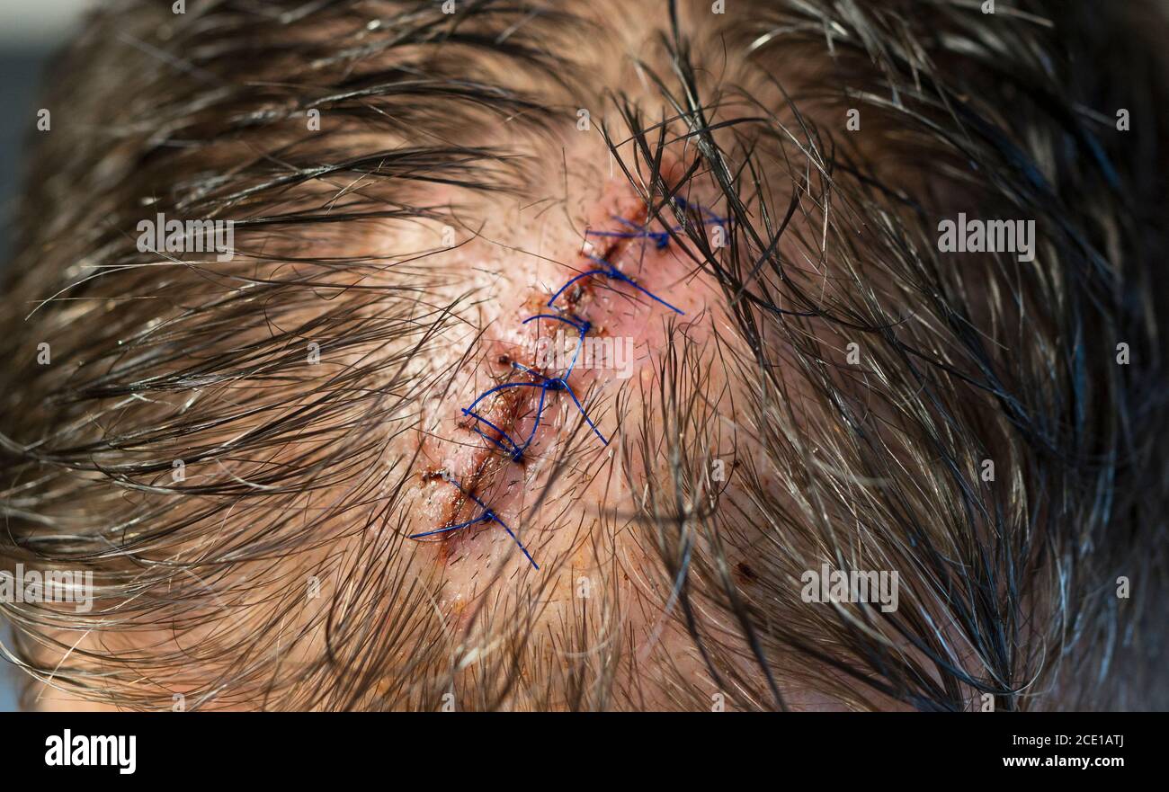 A stitched wound on the man's head. Close-up view. Stock Photo