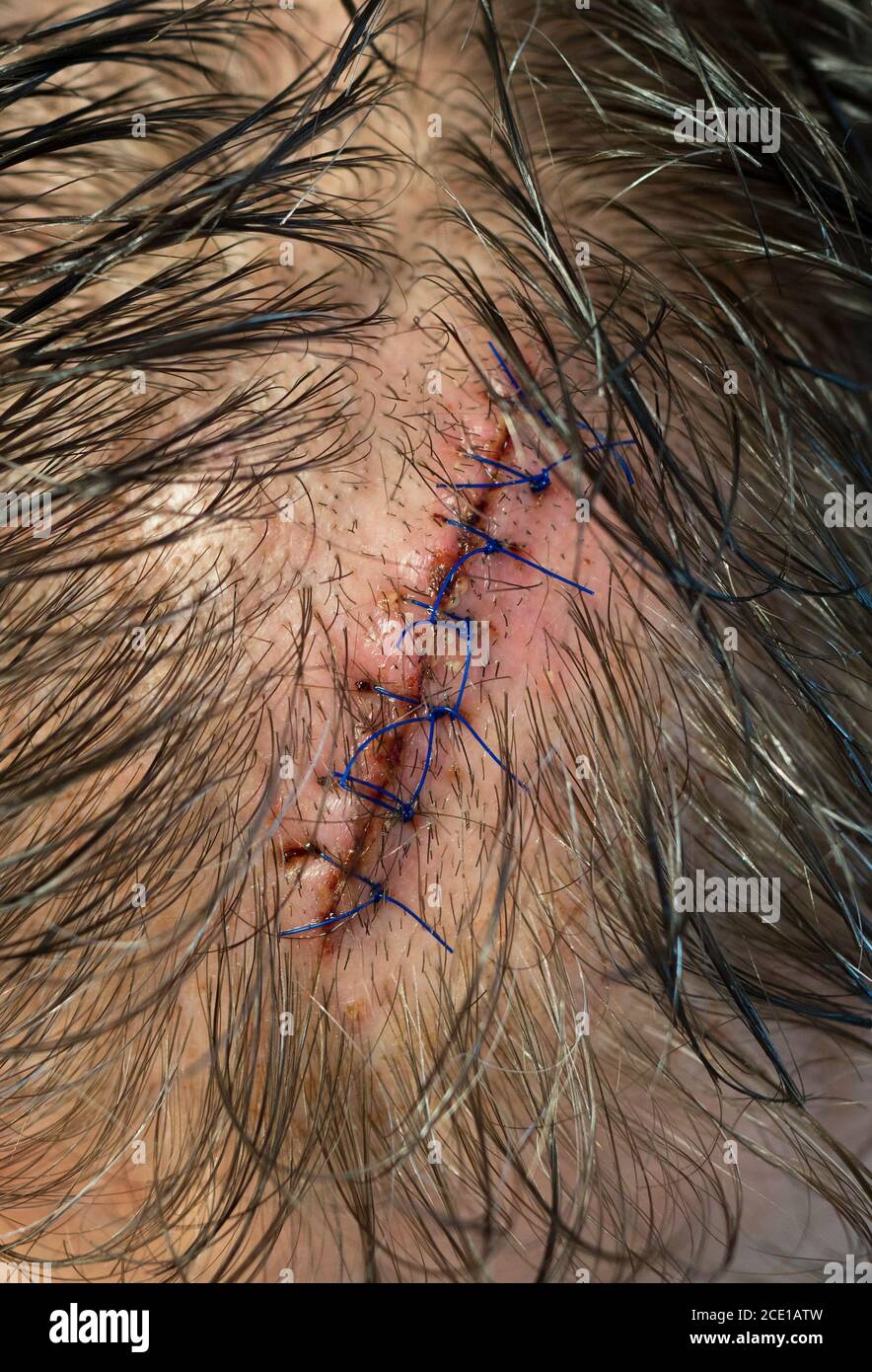 A stitched wound on the man's head. Close-up view. Stock Photo