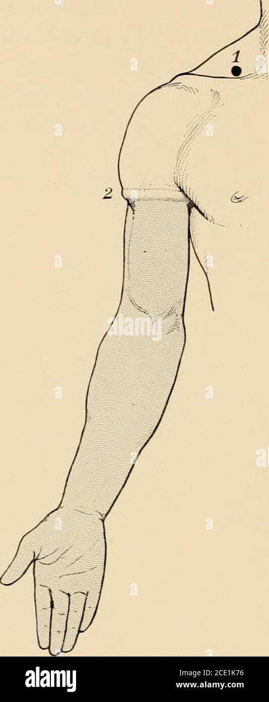 Brachial plexus block hires stock photography and images Alamy