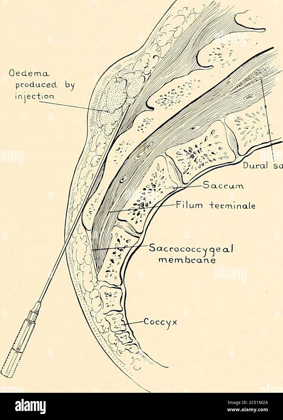 . Regional anesthesia its technic and clinical application . Fig. 212