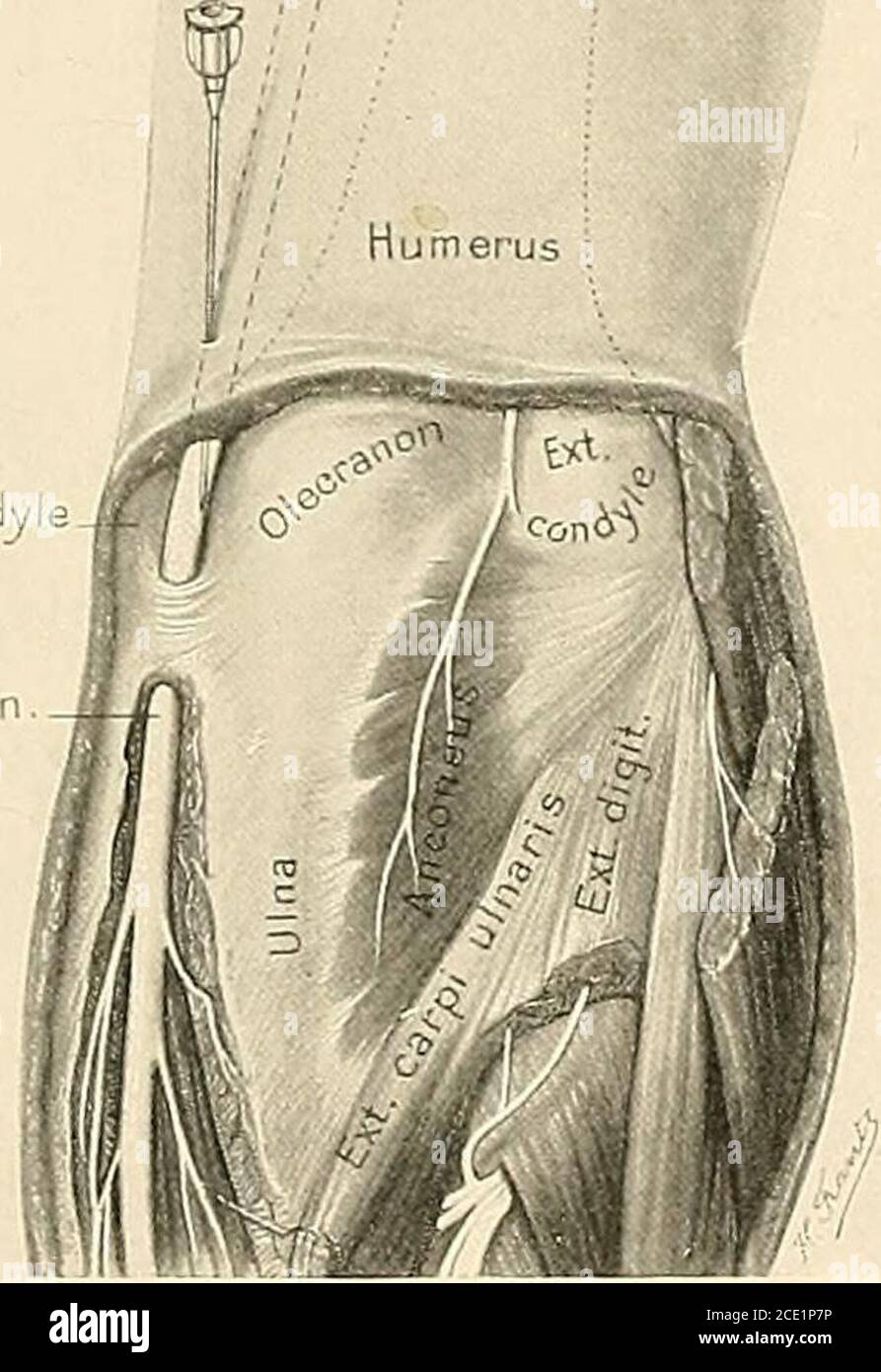 . Regional anesthesia : its technic and clinical application . he ulnar nerve arises from the inner cord of the brachial plexusand pursues a downward course in front of the triceps and to the innerside of the brachial artery. At about the middle of the arm it piercesor passes over the inner margin of the internal intermuscular septum,follows an inward and backward direction, and reaches the intervalbetween the internal condyle of the humerus and the olecranon, where BLOCKING OF SPINAL NERrES 211 it becomes so superficial that one can feel it rolling under the fingerbeneath the deep fascia. It Stock Photo