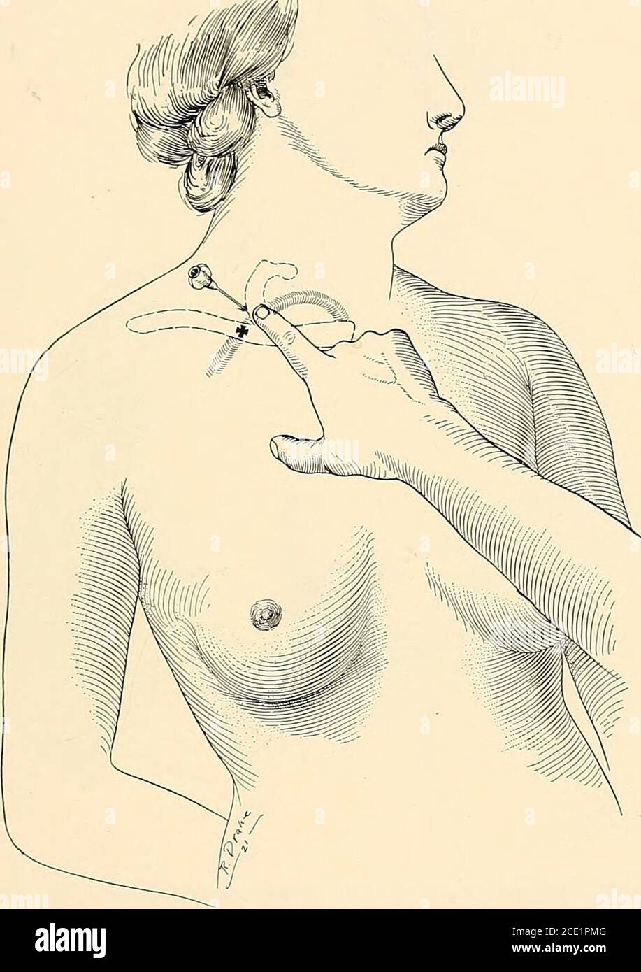 . Regional anesthesia : its technic and clinical application . Fig. 155.—Brachial plexus block by the supraclavicular route. The midpointclavicle is generally in the prolongation of the external jugular vein. finger the subclavian artery is retracted inward and downward and nee-dle No. 2 (5 cm.), unattached to the s&gt;Tinge, inserted through the whealclose to the tip of the index-finger, and advanced backward, downward,and inward toward the first rib (Fig. 156). BLOCKING OF SPINAL NERVES [93 The needle should be introduced gently and gradually after piercingthe deep fascia, since the brachial Stock Photo