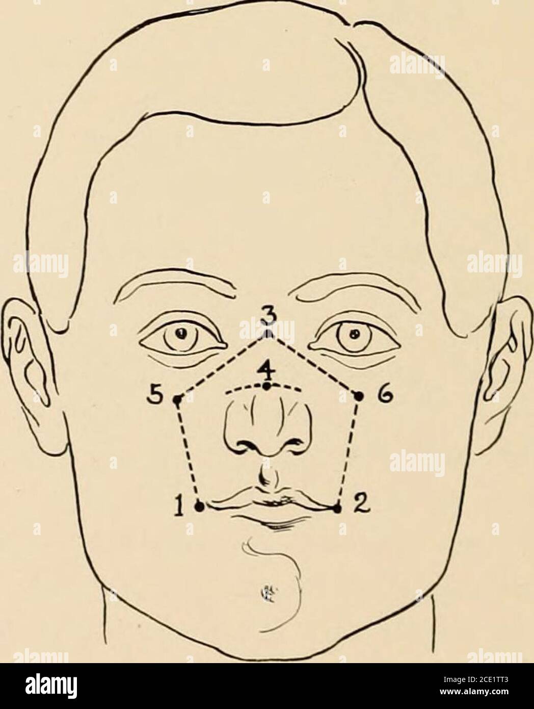 . Regional anesthesia its technic and clinical application . Fig. 107