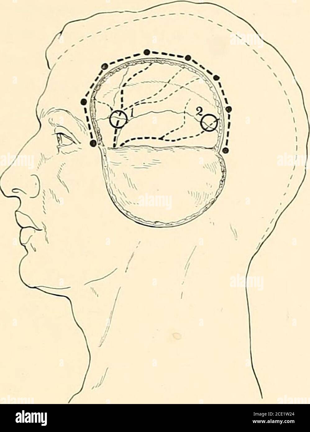 . Regional anesthesia its technic and clinical application . Fig. 98