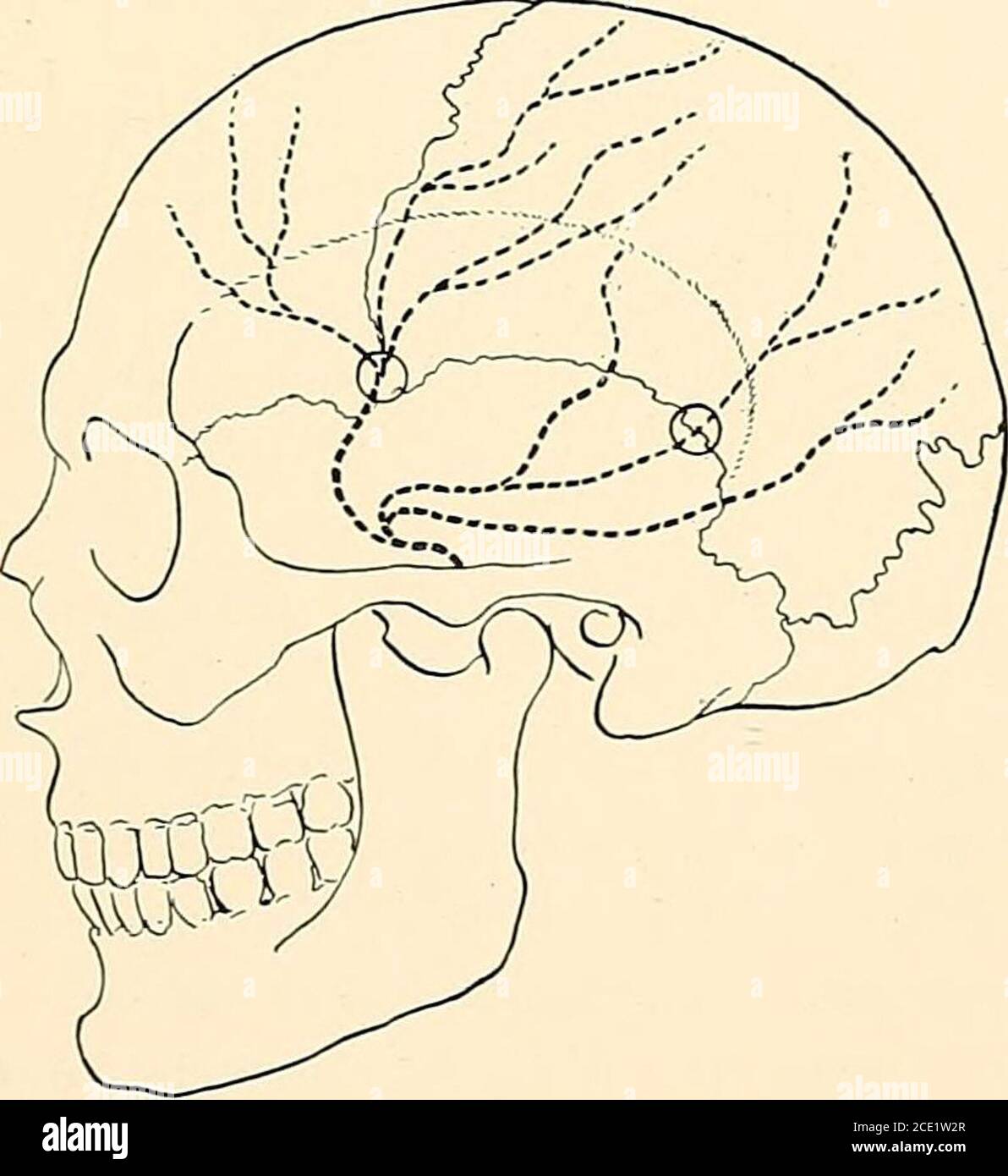 . Regional anesthesia its technic and clinical application . Fig. 99