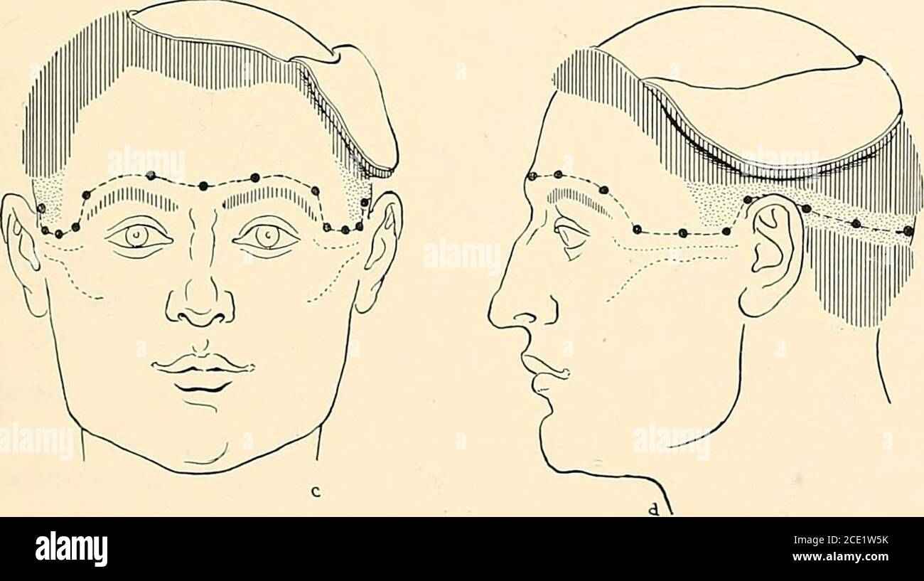 . Regional anesthesia its technic and clinical application . Fig. 96
