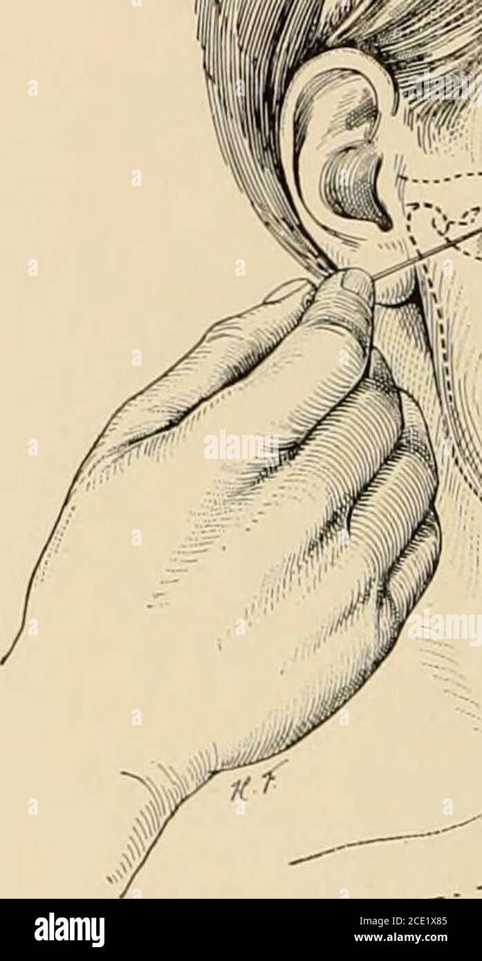 . Regional anesthesia : its technic and clinical application . Mandibular block by the extra-oral route (1). 2. Needle No. 3 (8 cm.) is inserted immediately below the midpointof the zygomatic arch and introduced transversely through the softtissues (Fig. 67) until it reaches the pterygoid process of the sphenoidbone, at about 5 cm. from its point of entrance. The recorder withwhich the needle has previously been provided is brought in contact 96 REGIONAL ANESTHESIA. Stock Photo