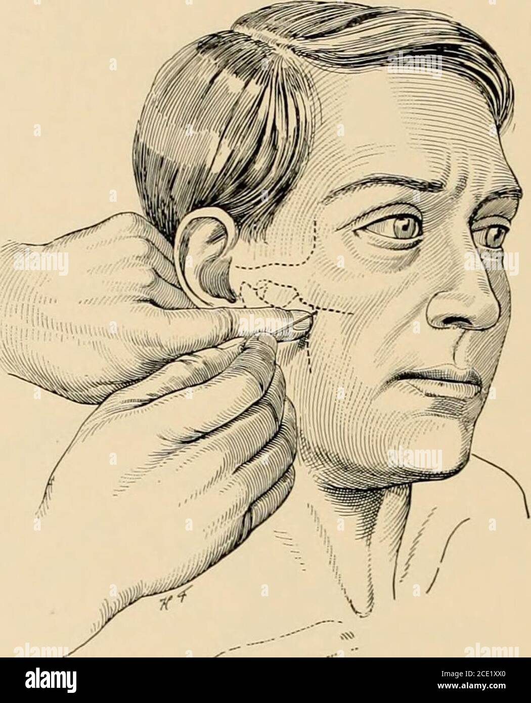 . Regional anesthesia its technic and clinical application . Fig. 52