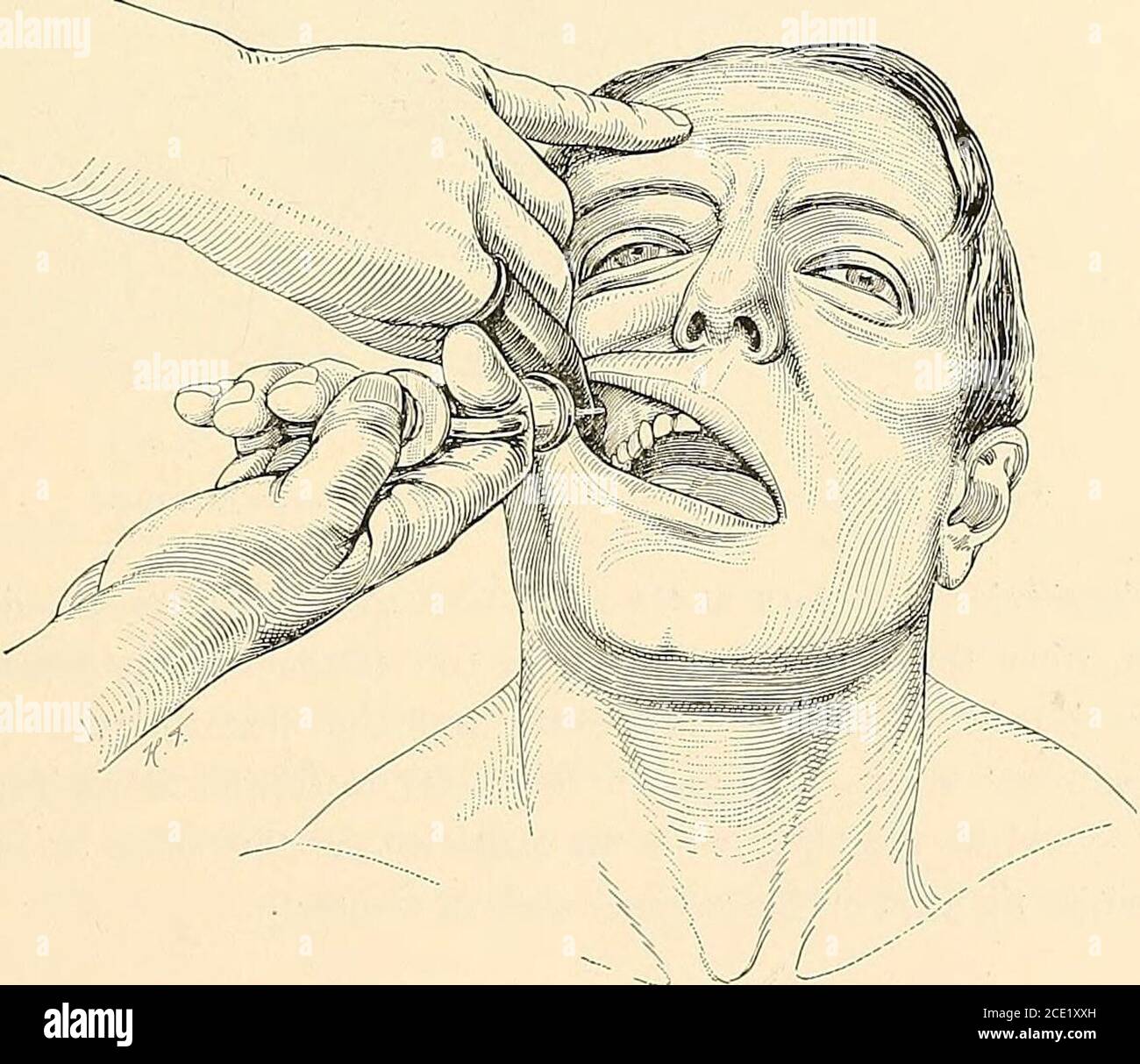 . Regional anesthesia its technic and clinical application . PalatmeNnSphenopalatlYve