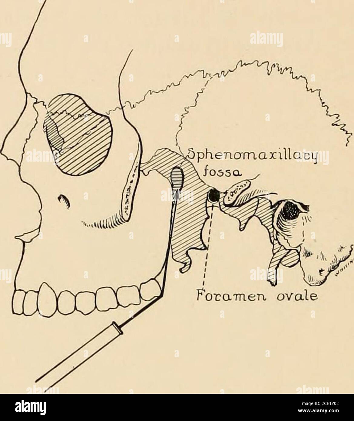 . Regional anesthesia : its technic and clinical application . Fig. 49.—Maxillary block by the oral route (1). Direction of needle (a) in relationto skeleton. maxilla and the pterygoid process and at a depth of from 3.5 to4 cm. reaches the sphenomaxillary fossa, where 2 c.c. of the 2 per cent,solution are injected slowly. Paresthesias obtained in the territory of the palatine nerves indi-cate that the point of the needle is in the correct direction. Injectionmay then be started while the needle is advanced about 0.5 cm. further,in the same direction, toward the maxUlary nerve. The palatine gan Stock Photo