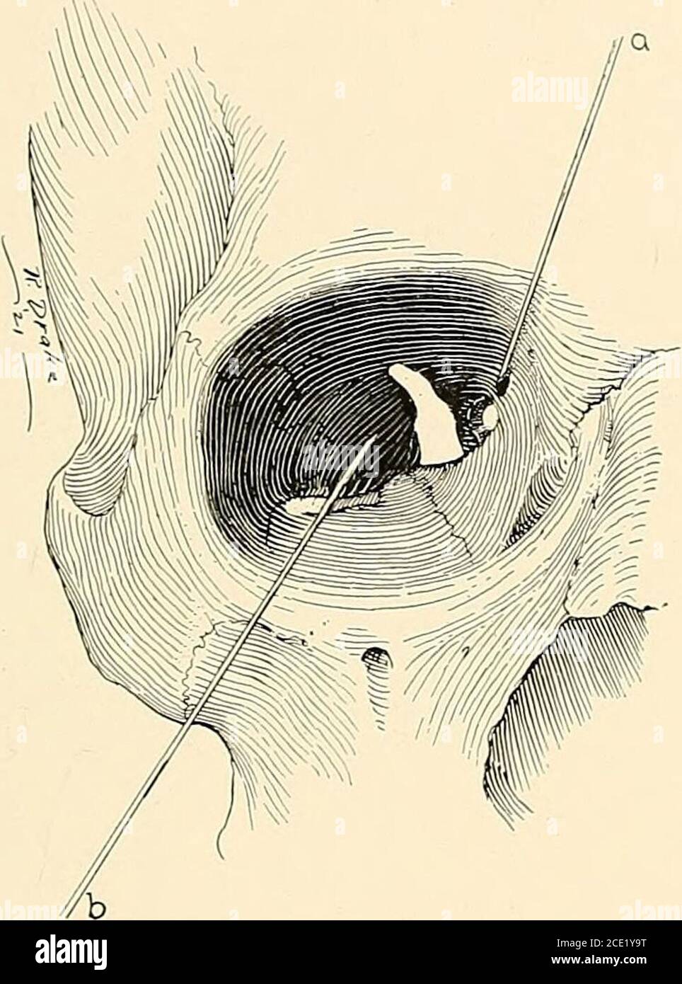 . Regional anesthesia : its technic and clinical application . fijie needle. Medial Orbital Block (Peuckart Route).—Vertically above thecaruncle and a little below the eyebrow, that is to say, at about 1 cm.or one fingerbreadth above the inner canthus (Fig. 40, a), needle No. 2is introduced along the upper medial angle of the orbit, keeping closecontact with the bony surface, until a depth of about 3.5 cm. is reached;2 c.c. of the 2 per cent, solution are then injected. The medial orbital block is ordinarilv associated with the lateral BLOCKING OF CRANIAL NERVES 71 orbital block for operations Stock Photo