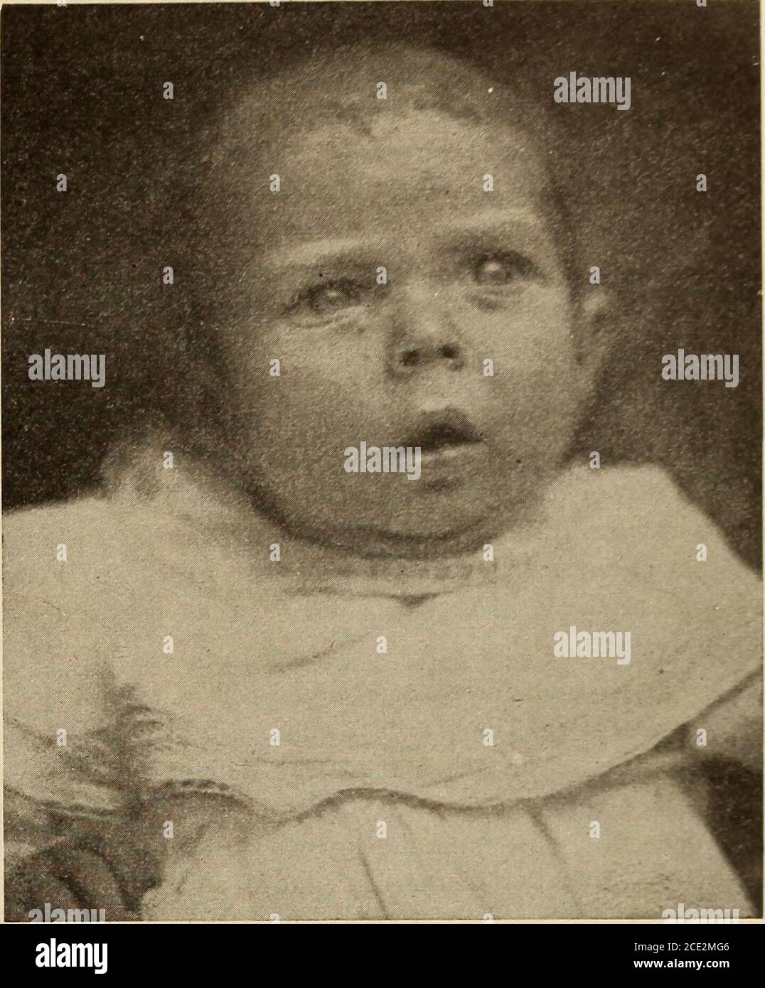 . Diseases of infancy and childhood . ved equalparts of milk and water