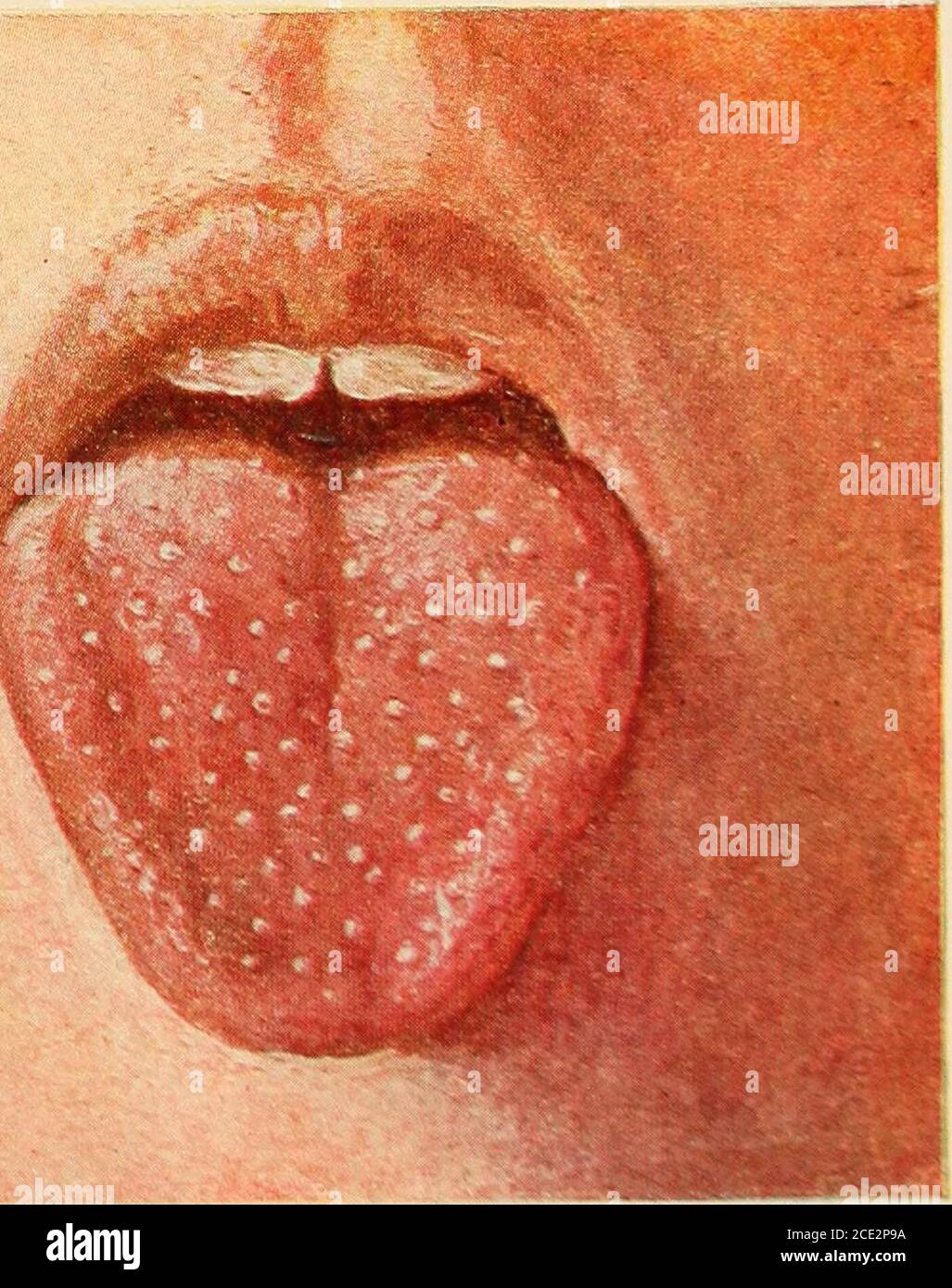 Scarlet fever mouth with symptoms of scarlatina Vector Image