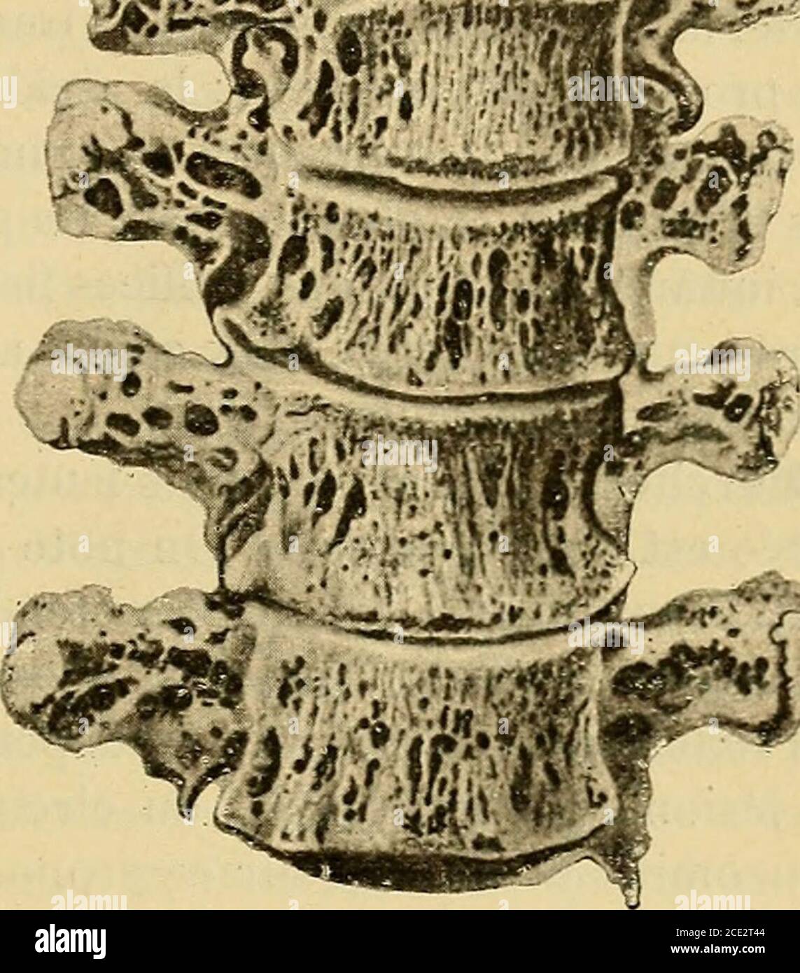 . Traité de chirurgie clinique et opératoire . ent séreux, parfoiscaséeux, contenant des grainsjaune soufre un peu brunâtre, assez durs, et dans des proportions fort variables. Ponfick, Moos-brugger, Garré, Partsch, etc., regardent la suppuration comme lefait dune infection mixte. Laclinomycose osseuse primitive est encore à démontrer, affirmentde nouveau Guermonprez et Becue (2). En effet, laclinomycosepénètre le plus souvent dans les parties molles qui avoisinent lescavités digestives et respiratoires, il nenvahit que secondairement letissu osseux. Ainsi, ce ne sont que des portions de squel Stock Photo