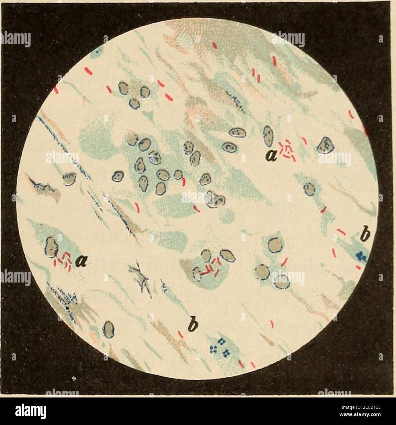 . Diseases of infancy and childhood . nal origans suffer from the invasion of the TUBERCULOSIS. 437 tubercle bacillus in this connection. Jlie lungs and tlie pleura, tlie peri-cardium and myocardium, the liver, spleen, and kidneys, the coverings ofthe brain, and the brain itself are frequently affected. The question of the transmission of the tubercle bacillus is one thatis still debatable. Thus Jani reports in Virchows Archiv, Bd. 103^ p. 522,that the seminal fluid of tuberculous persons contains tubercle bacilli. Thecases of tubercles in the foetus are described by Johne and Armanni.^ Bang,L Stock Photo