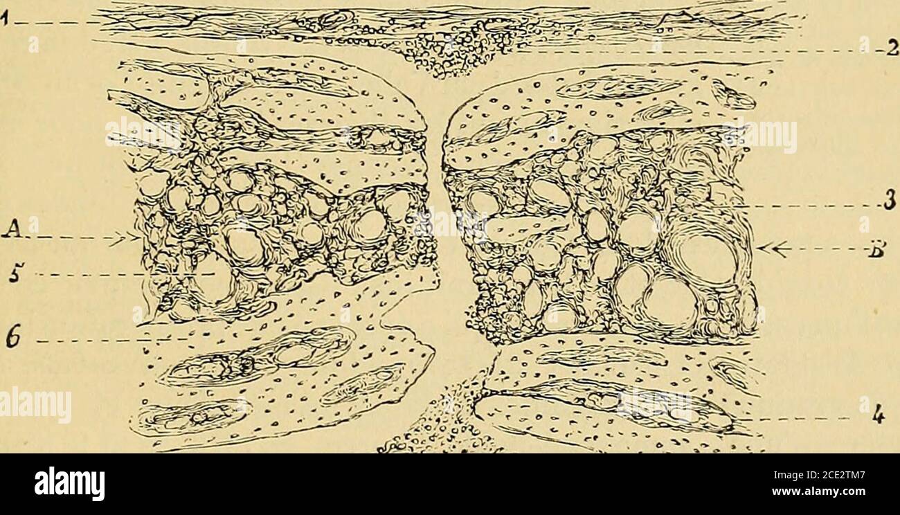. Traité de chirurgie clinique et opératoire . Sfcfcu. Fig-. J35. — Section suivant la diaphyse dune côte malade (Pellizzari et Tafani). —1, périostite ; 2, substance compacte de la diaphyse réduite en lamelles; 3, 4, 8,transformation fibreuse de la moelle tant dans la cavité centrale que dans lescanaux de la substance osseuse superficielle ; 5, infraction de la côte; 6, tissu•osseux normal ; 7, moelle peu altérée.. L.C Kg. 136. — Coupe dune côte fracturée (Pellizzari et Tafani). —A, 13, extrémité desfragments; 1, périoste infiltré de globules purulents; 2, pus ; 3 et 4, transforma-tion fibreu Stock Photo