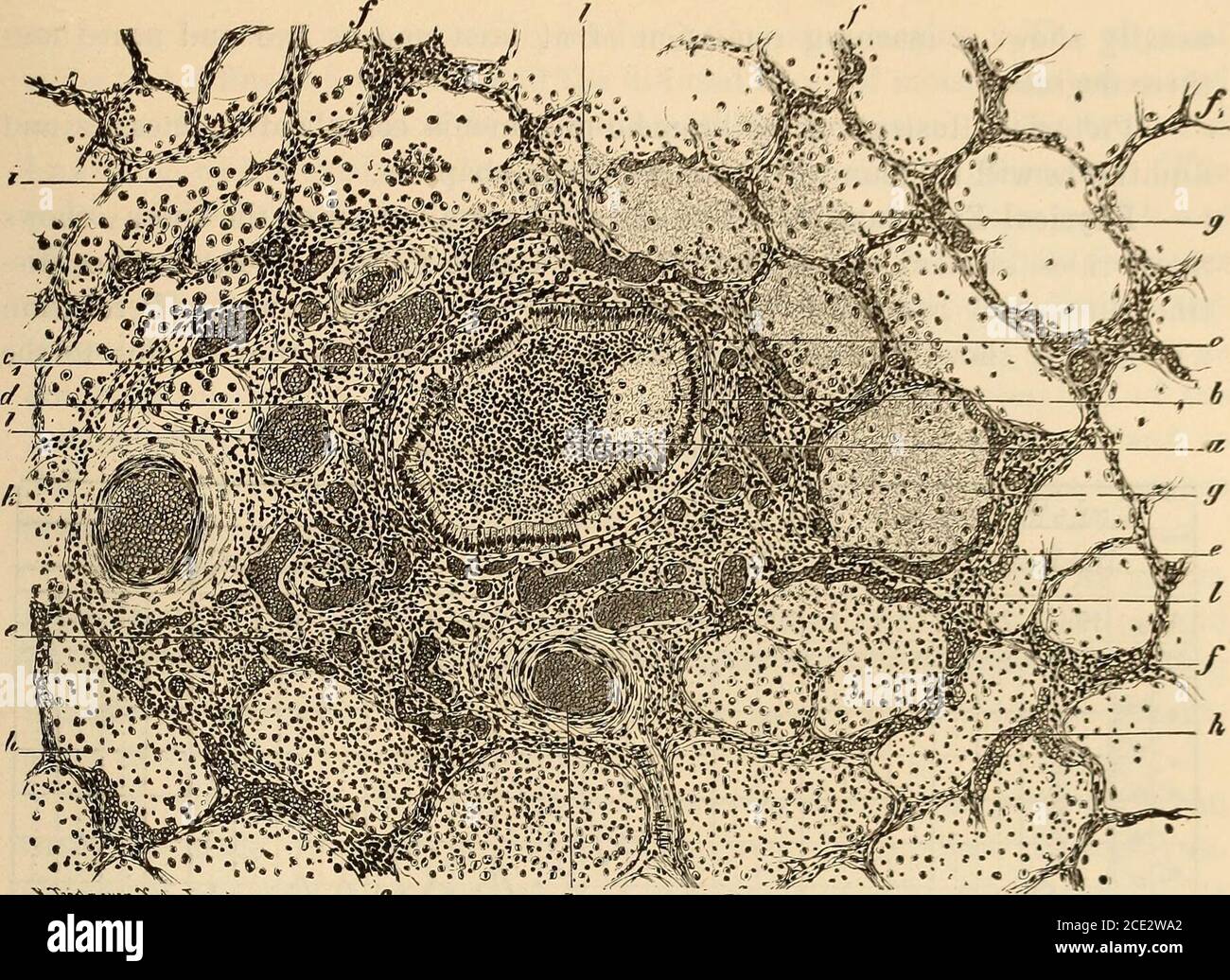 . Diseases of infancy and childhood . Fig. 135.—Diplococcus Pneumoniae (Pneumococcus) : {a) single diplo-coeci; (6) the same in chains (Wolfs double stain). Leitz ocular I, oilimmersion Via- (Lenhartz-Brooks.) Pathological Anatomy.—The tracheal and bronchial mucous mem-brane is intensely congested, and the lumen of the smaller bronchi filledwith thick muco-pus, which adheres to the surfaces and is as tenacious asa pseudo-membrane. The lung at the seat of infection shows dark brownor brownish-red, infiltrated areas, sometimes of a bluish-red color. Thesurface of the pleura contains large or sma Stock Photo