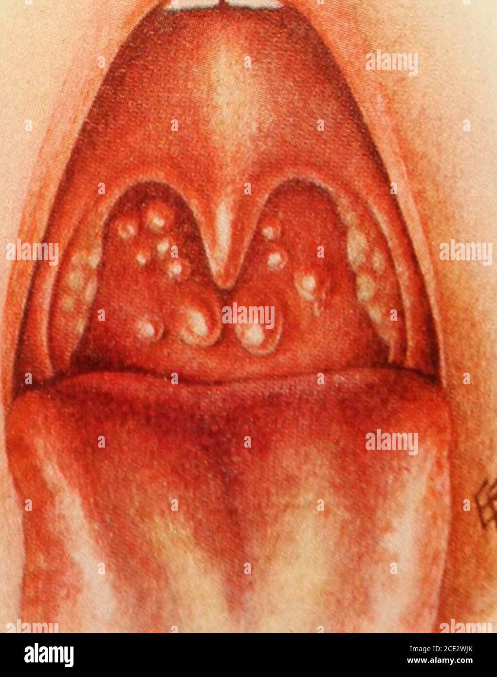 Diseases Of Infancy And Childhood Chronic Enlarged Tonsils And Associated Congested Throat Very Frequently Seen Original A Ciise Of Graniiliir Iharyngitis Large Masses Could Bo Paljutod Iu Therhino Pharynx Original A 7 N I F
