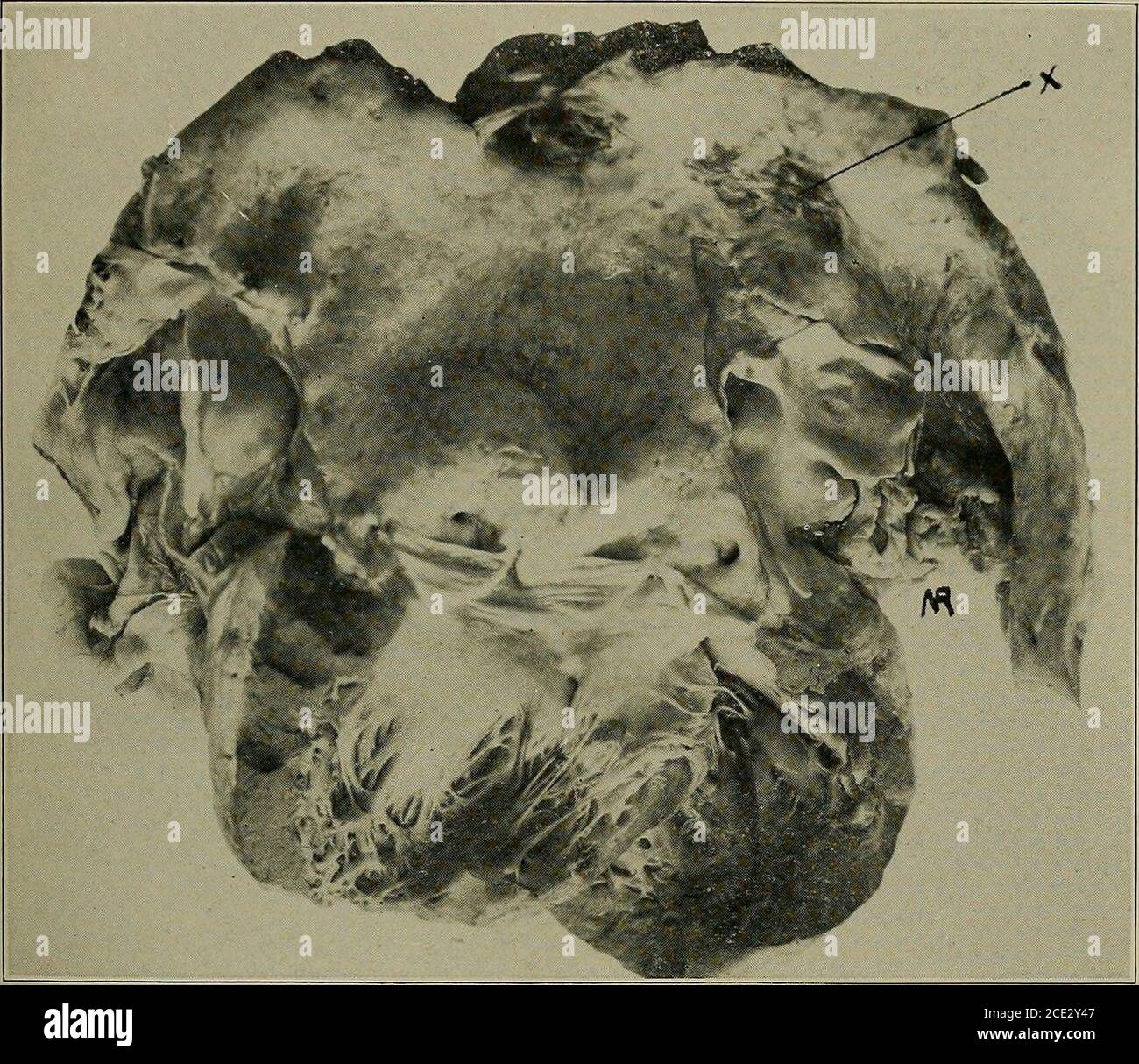 . Syphilis : a treatise on etiology, pathology, diagnosis, prognosis, prophylaxis, and treatment . Fig. 97.—This shows a generally dilated aorta in walls of which are numerous foci ofmore severe damage at which secondary dilatations have occurred. Multiple secondaryaneurysms. One of these small aneurysms has perforated into the superior vena cava(X). (Courtesy of Dr. Paul G. Woolley.) the initial lesion, although it may, of course, make its appear-ance at a much earlier date. Certain authors feel that free in-dulgence in alcohol may be a predisposing factor. Since mostof the cases occur in men Stock Photo