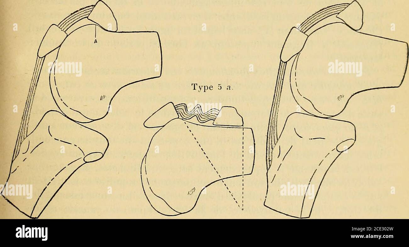 Traité de chirurgie clinique et opératoire . Type 4 h. Type 5 b.. Fig. 47.  — Consolidation des fractures transversales de rotule (Chaput). — Type 2  :arrêt de la flexion par