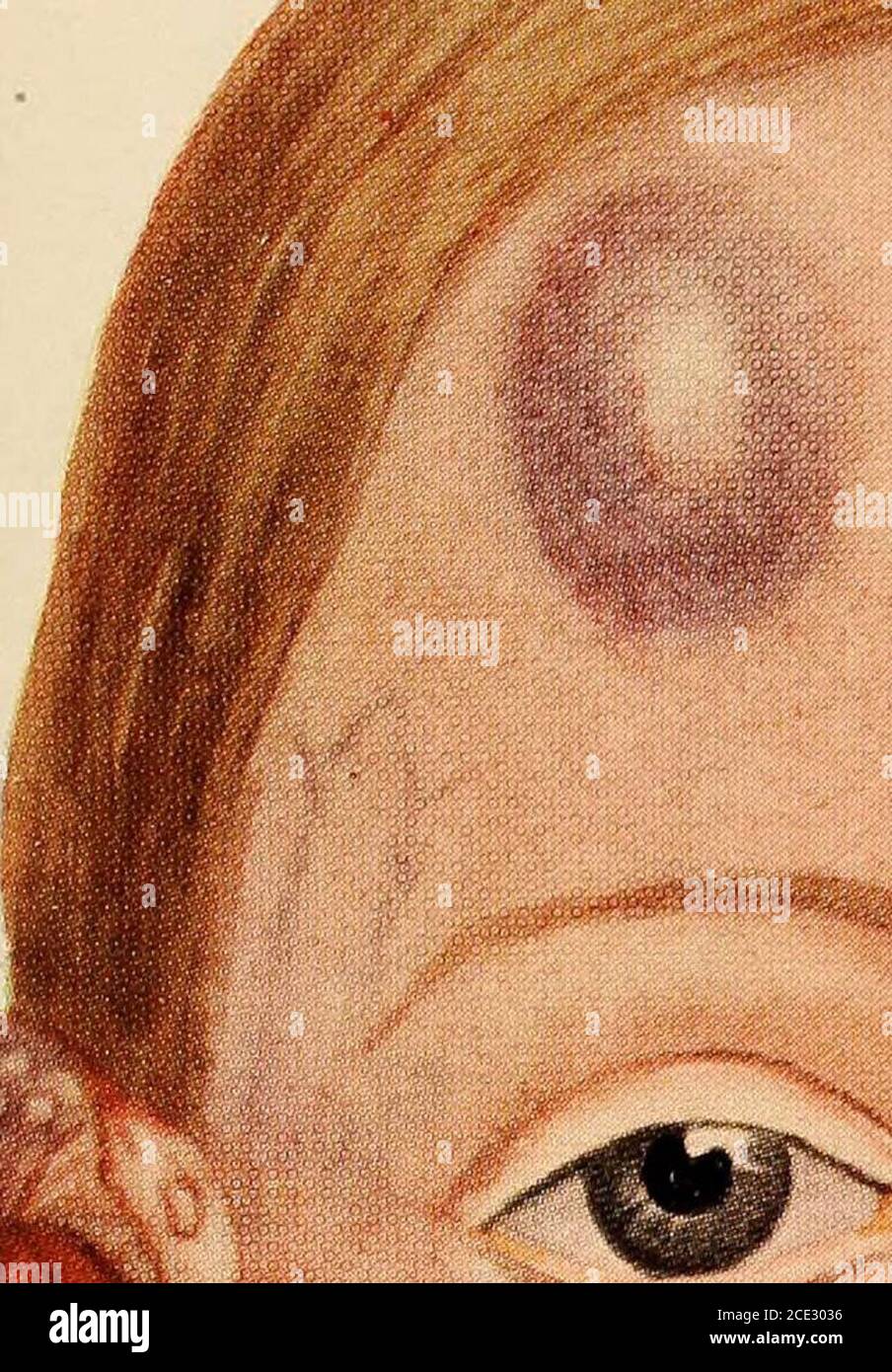 . Diseases of infancy and childhood . physiological condition of thedigestive function in infancy. 6. It must be fresh and sound, free from all taint of sourness ordecomposition. Pathology.—Haemorrhages in and around the joints and in the mus-cles are found post-mortem. The most important point, however, is thepresence of subperiostial haemorrhage involving the long bones. Eotchstates that the femora are the most commonly affected, and that there isa tendency to a separation of the epiphyses. Interstitial haemorrhage in-volving the lungs, spleen, kidneys, and interstitial glands has been found Stock Photo