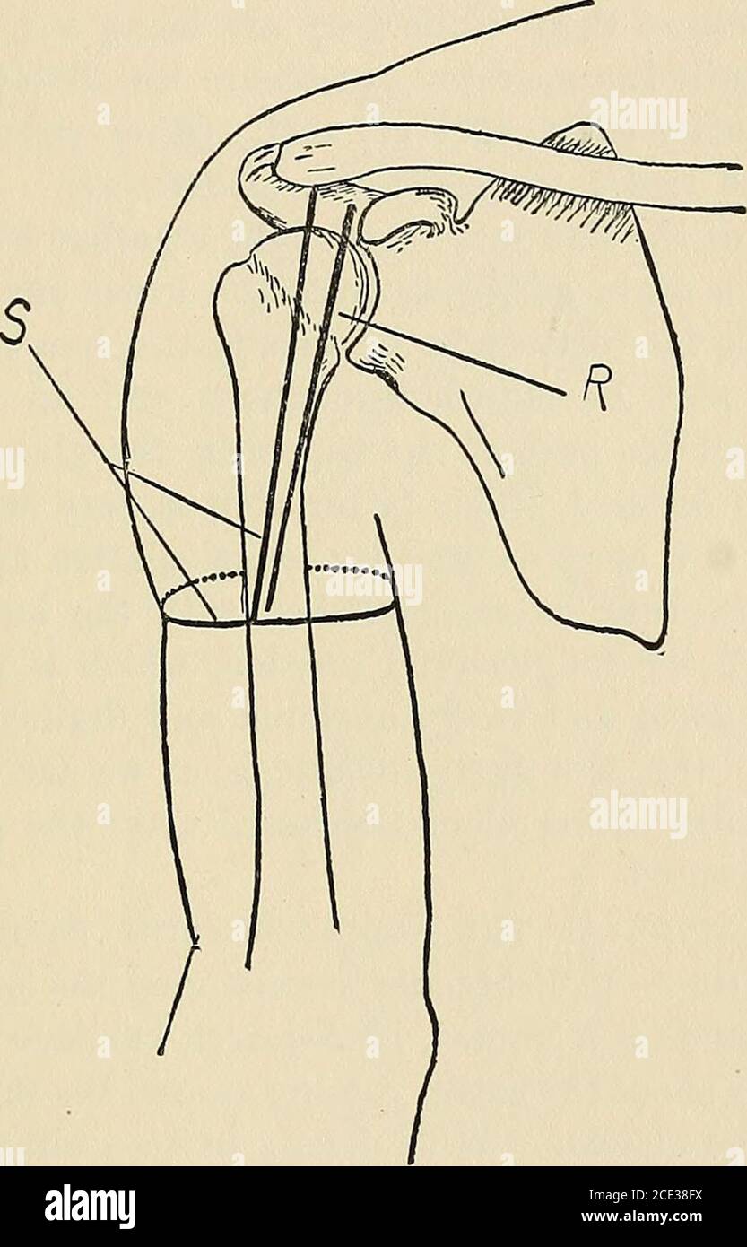 . Operative surgery, for students and practitioners . rficial fascia ...