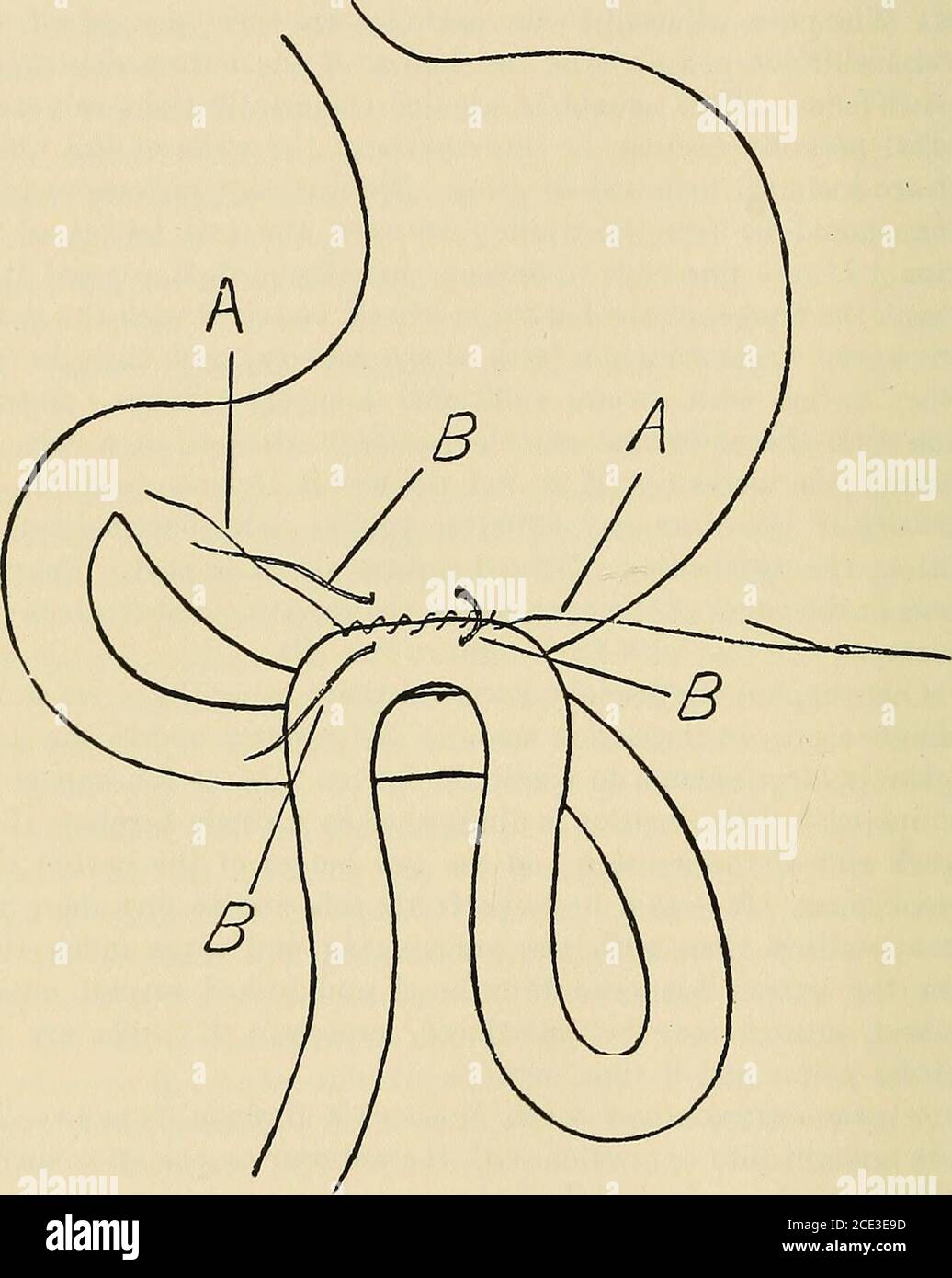 Laparoscopy, SILS, and NOTES for Acute Appendicitis | SpringerLink