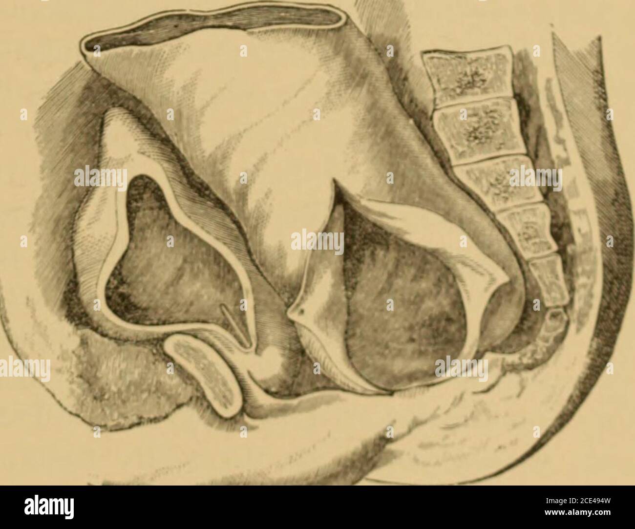 . A system of obstetrics . point the making of a crucial incision, one portion running antero-pos-teriorly, and the other laterally. The puncture should be made at thedark point in the membrane which indicate- the centre ..t* the ami-.The incisions should be made with a probe-pointed bistoury. Theimmediate effect of the operation is the discharge of the accumulatedmeconium and relief of the most distressing symptons. Itthe mem-brane is very thin, the flaps formed by the crucial incision may !».• Into disappear by absorption, or they may be removed by scissors. Itthe membrane is thick, the flap Stock Photo