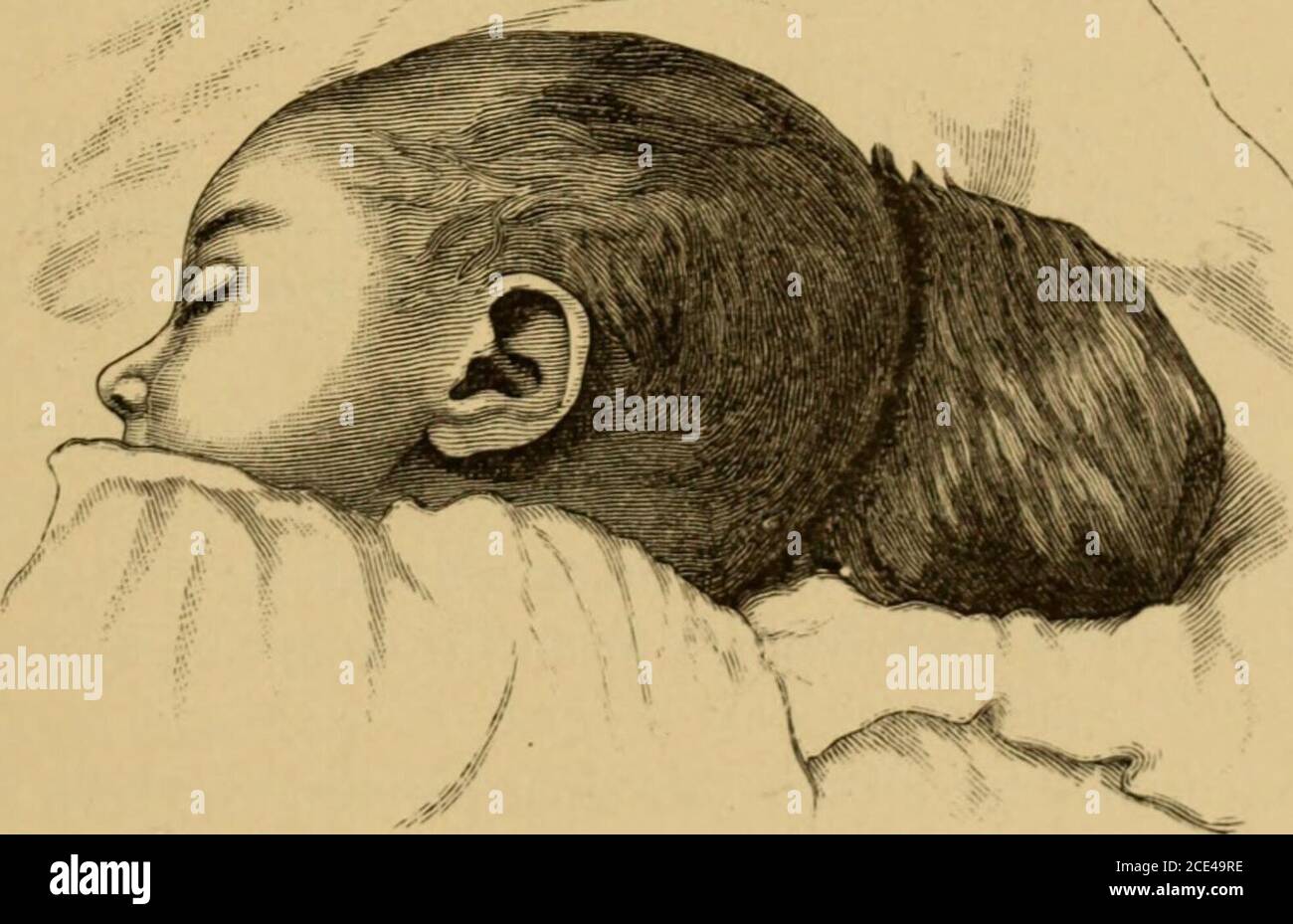 . A system of obstetrics . through which the pro-trusion takes place is at the median line, or near it, anterior or pos- MENINGOCELE, ENCEPHALOCELE, HYDRENCEPHALOCELE. 655 terior to the occipital protuberance. The opening, if in the anteriorpart of the occipital bone, may extend to the fontanelle; if in the pos-terior part, it may extend to the foramen magnum. It may connectposteriorly through the foramen magnum with the cleft of a spina bifida.If the opening in the occipital bone be large, the tumor is also usuallylarge. Prescott Hewitt cites a case in which it extended to the loins;but so la Stock Photo