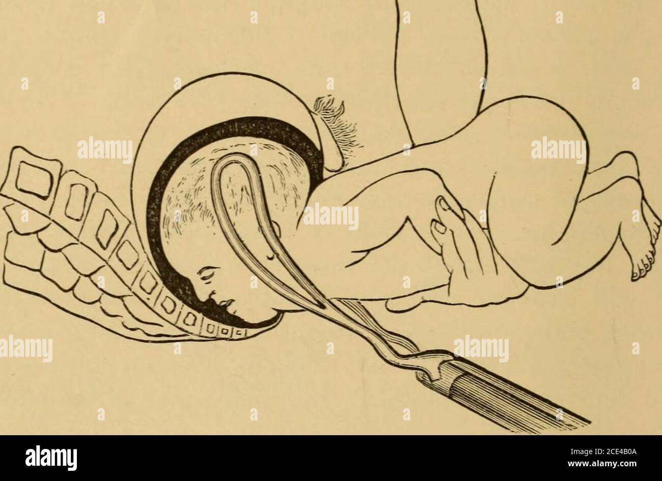 . A system of obstetrics . Practically, the blades do not grasp the head exactly in its antero-p rterior diam-eter, hut in an oblique direction intermediate between the antero-posterior and transvi ree. 1 h is argued by the advocates of iliis plan thai lateral compression is more apt (•&gt;overcome disproportion by increasing the sntero-poeterior measurements at the expense&lt;it i he lateral, and that compression sntero-posteriorly is apt t increase the dispropor-tion by bulging out the head laterally. Though theoretically plausible, practicallythis vim is incorrect; for experiments have abun Stock Photo