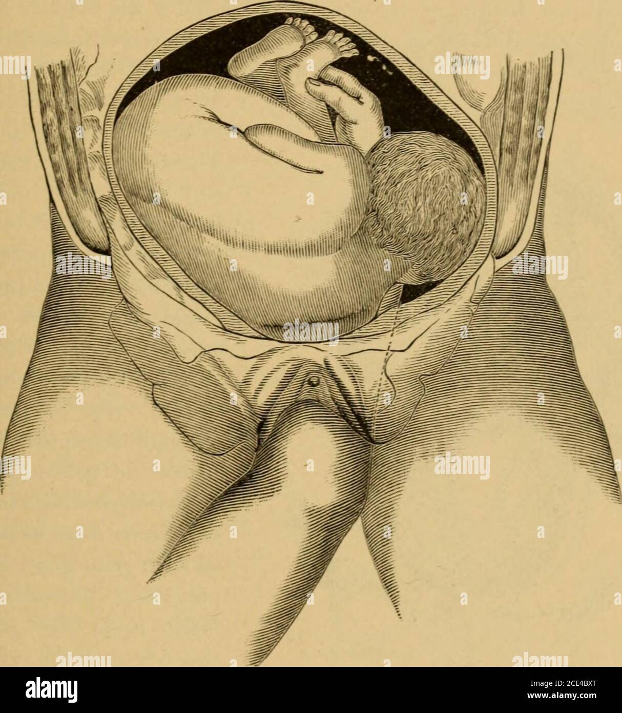 . A system of obstetrics . Internal Podalic Version. French method ...