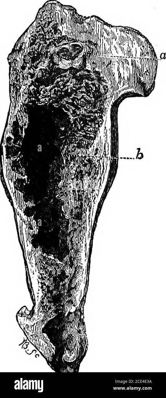 . The principles and practice of veterinary surgery . Fio. 27. Fig. 28. Fia. 27.—External view of humerus of a horse, with central abscess. Pie. 28.—Internal view of same bone. At a is a well-defined abscess,containing inspissated pus; 6 shows the dilated condition of the medul-lary canal, the cavity being originally filled with pus. An abscess may form within the cancellated structure, whichis hollowed out, as in the illustration, and is generally situatednear the articular extremity of a long bone. The same amountof inflammation necessary to produce pus ia the canceUi, would;if situated in t Stock Photo