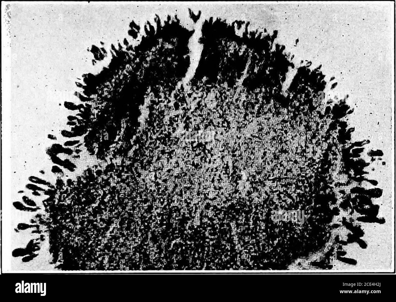 . Pathogenic microörganisms; a practical manual for students, physicians, and health officers . ors showed in all cases but one the presence oftypical actinomyces colonies, in most cases with typical clubs. The The ACTINOMYCES 469 general histological appearance of the tumors was like that of actino-mycotic tissue. Wolf in a later paper reports that an animal inoculated in the peri-toneal cavity with a culture of the same organism had lived a yearand a half. At the autopsy several tumors were found in the peritonealcavity, and in the liver a large typical tumor in which were manycolonies whic Stock Photo