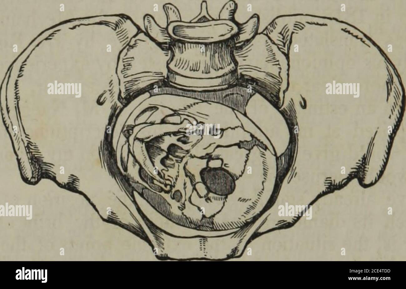 . On the theory and practice of midwifery . iew, a table of corresponding numerals of dif-ferent authors. Numbers affixed to Presentation by Description of Presentation. ?o tj S • e G9 JB 2 o ?- Mbo 3 5! £ a. ao iti5 a s O i Anterior part of Craniumpointing to (Q = o s o ?goo &lt;d « SO-sOE «Q«QQ a «KS M 1 1 1 1 1 3 Right sacro-iliac synchondrosis. 2 2 2 2 4 Left do. do. 2 3 4 3 4 6 Left foramen ovale. 4 6 4 5 5 Right do. 3 3 7 Promontory of sacrum. 6 6 8 Symphysis pubis. 6 7 1 Right os ilium. 6 8 2 Left do. 209. Now let us trace the progress of the head in the different posi-tions. 204 MECHAN Stock Photo