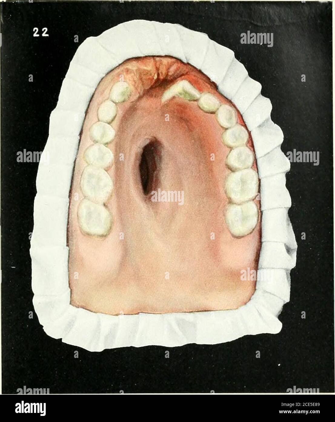 Mouth destruction