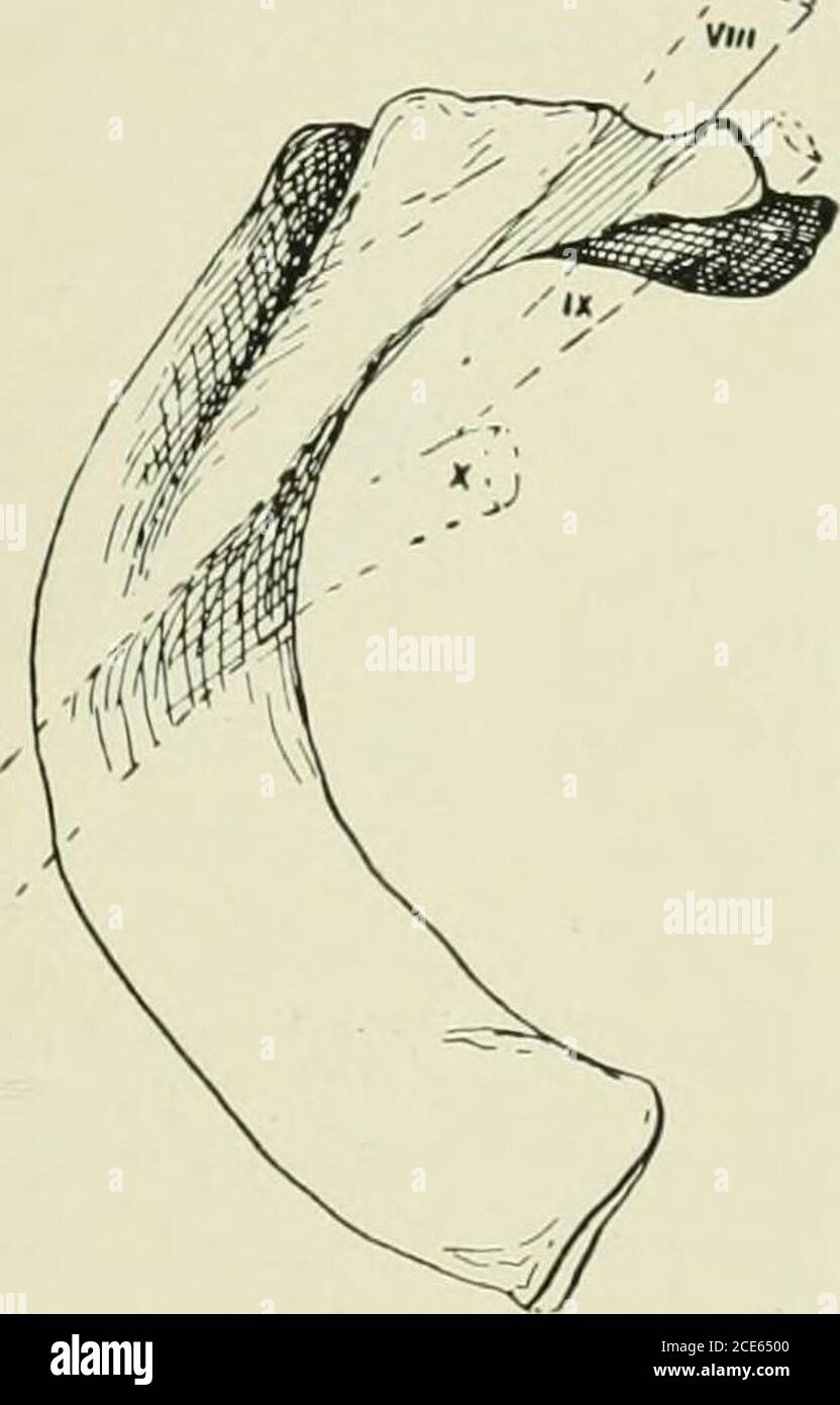 . Journal of anatomy . Fig. 3.—Type of rudimentary rib, classI., in