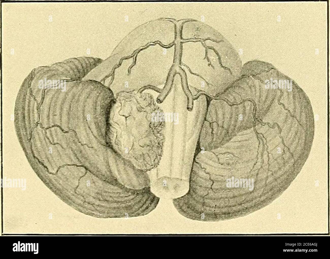 . Some points in the surgery of the brain and its membranes . Fig. 121.—Fibro-plastic tumour of Lebert, 1851. The specimen was shown by M. Broca at the Anatomical Society of Paris. Thetumour was growing from the pia mater, the vessels of this membrane ramifying onboth surfaces. The cerebellum and pons were hollowed out to receive it, but thesubstance of the brain was not invaded by the growth. The external surface was ofa reddish grey colour. On section the surface was of an ashy grey colour, withvascular streaks and blaclc patches of haemorrhage. The consistence of the tumourwas firmer than t Stock Photo