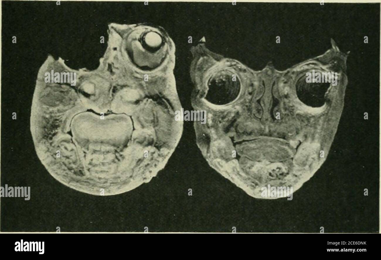 . Journal of anatomy . -MA tS Dl OL e. Fig, 1.—Coronal section of the face of a Cyclopean monster (Mus.Anat. Cant, specimen HC ), drawn with Edingers pro-jection apparatus. the septum is reduced to the merest downward projection. No retinalelements have been detected {cf. condition described in cyclopia by Leonowa,Archiv filr Psychiatrie, Band xxxviii.). The maxillary processes havefused to form the hard palate. The posterior orifice of the conjoined nasalfossae is reduced to a mere pinhole aperture. Cyclopean F(l4iis with Hernia Encephali 59 II. Eyeball and Retina. The eyeball presents no mar Stock Photo