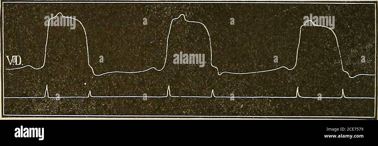 . A text-book of physiology : for medical students and physicians . ation of at least two factors,—a valvularelement due to the vibration of the auriculo-ventricular valves, anda muscular element due to the vibration of the contracting muscularmass. Accepting this view, there is a further difficulty in explain-ing the origin of the muscular element. According to some, it isdue to the fact that the contraction of the muscle fibers is not 554 CIRCULATION OF BLOOD AND LYMPH. simultaneous throughout the ventricle and the friction of the inter-lacing fibers sets up vibration in the muscular mass; a Stock Photo