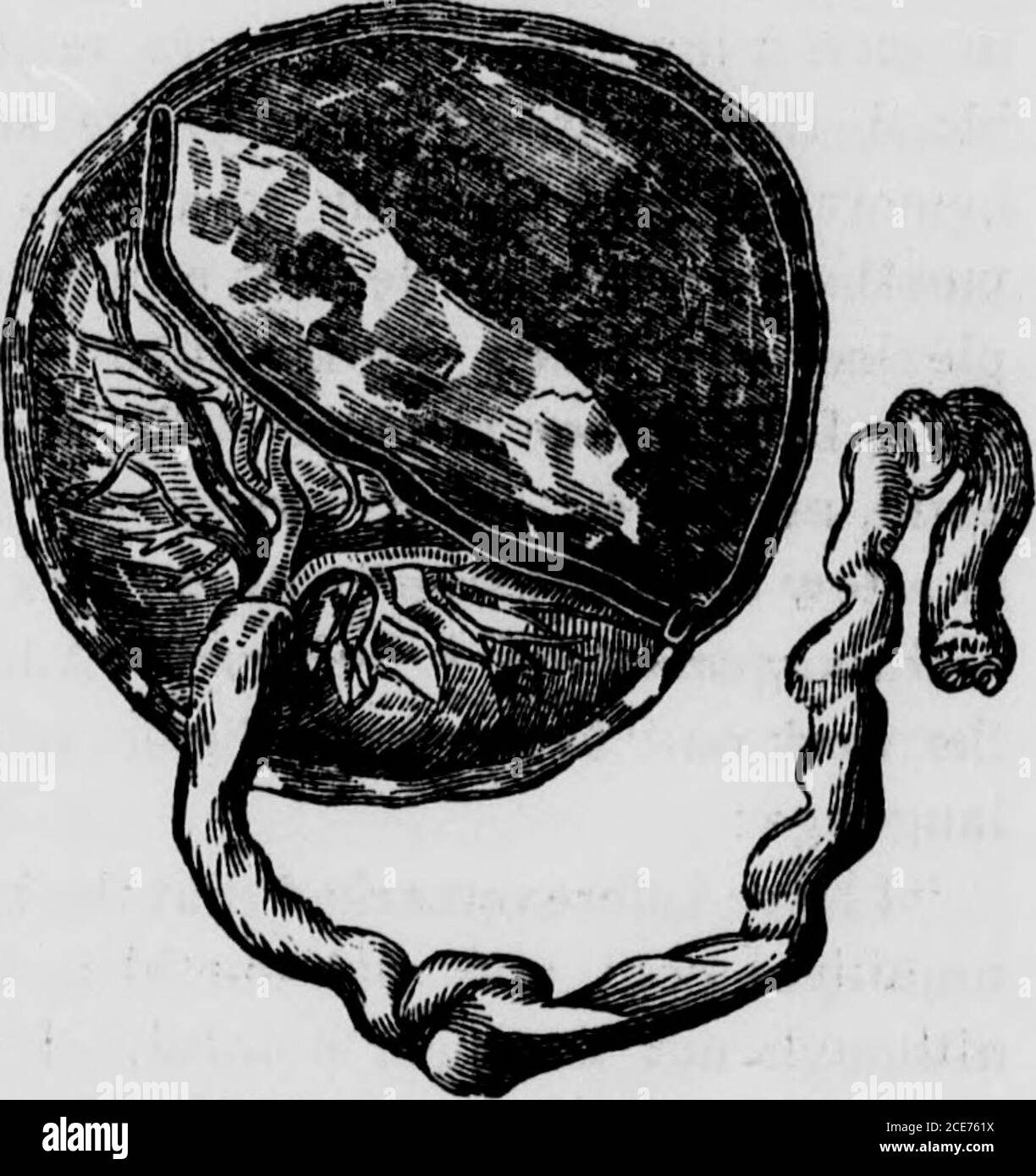 Umbilical cord accidents Black and White Stock Photos & Images Alamy