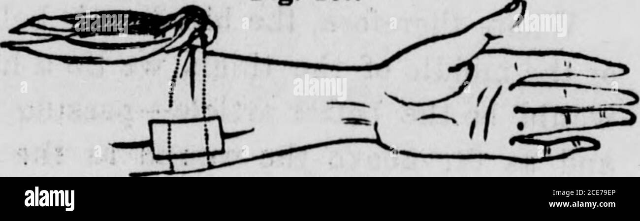 . The hydropathic family physician : a ready prescriber and hygienic adviser with reference to the nature, causes, prevention, and treatment of diseases, accidents, and casualties of every kind . AKKK8T1NO HEMORRHAGE.. AEBK8TINO HKMOKEH 1GB. lifted up, in order to expose the bleeding vessel. O.ace it is discov-ered, the point of a little hook—tenaculum, as it is technically termed 28* 658 Of Wounds, Hemorrhages, etc. -—should be dipped into the wound as near the bleeding vessel as maybe, and drawn up so that a strong thread of linen or silk may bepassed around the part below the instrument. Th Stock Photo