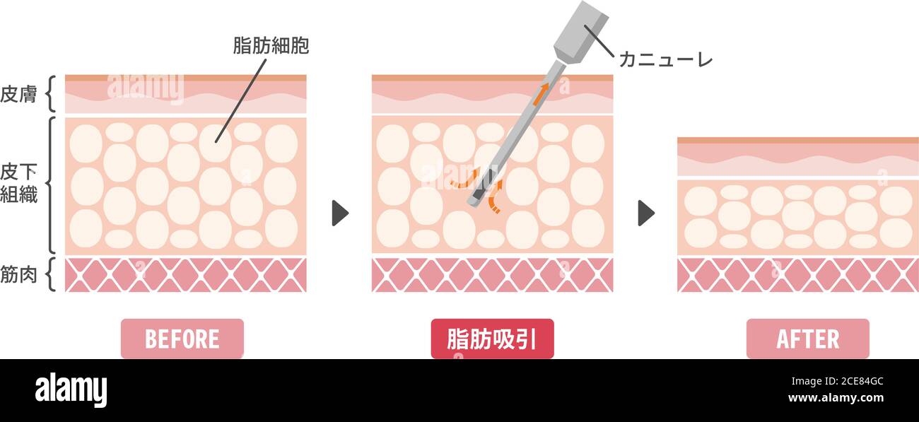 Liposuction process vector illustration / sectional view of skin Stock Vector