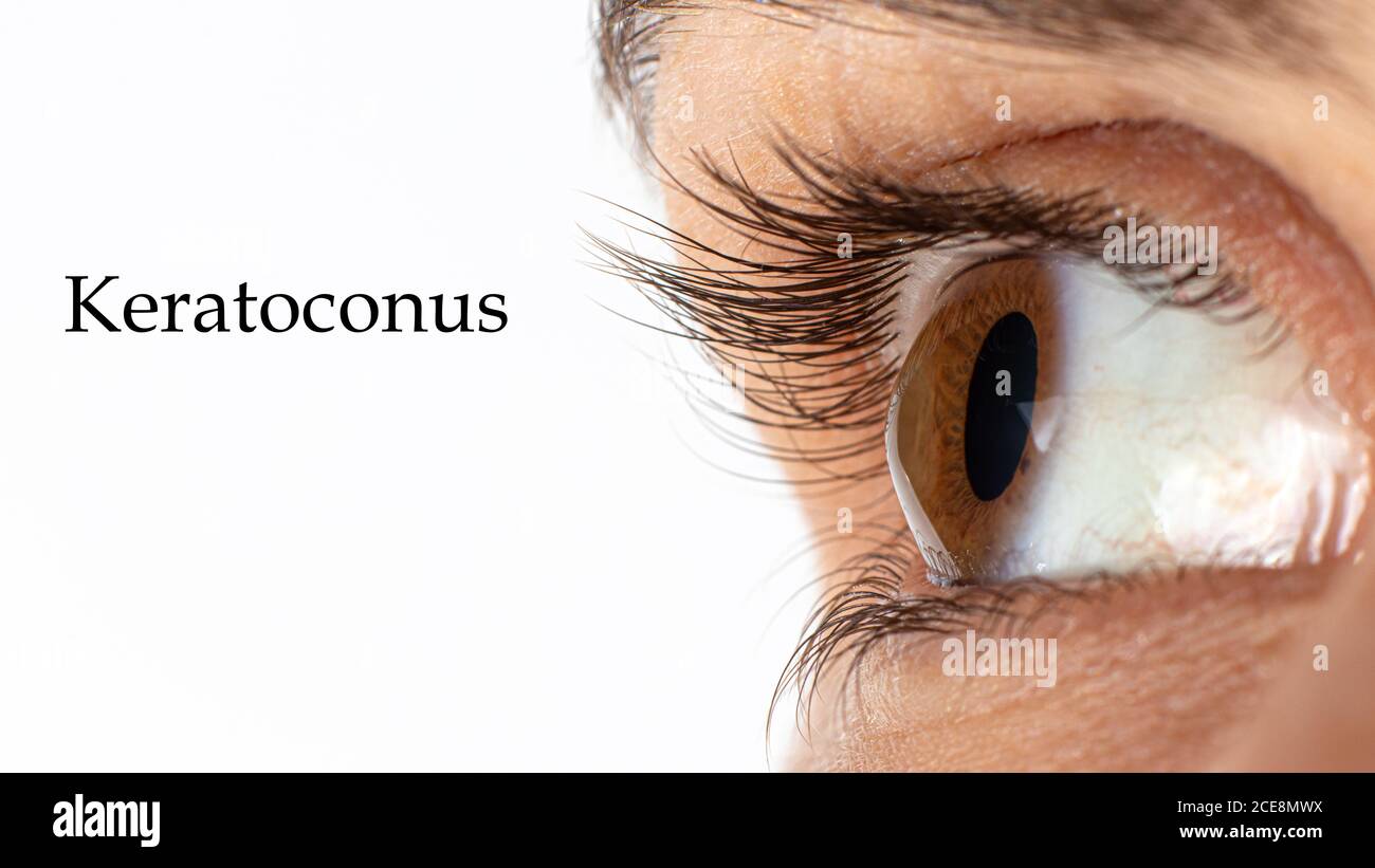 Macro eye photo. Keratoconus - eye disease, thinning of the cornea in the form of a cone. The cornea plastic. Close up, banner. Stock Photo