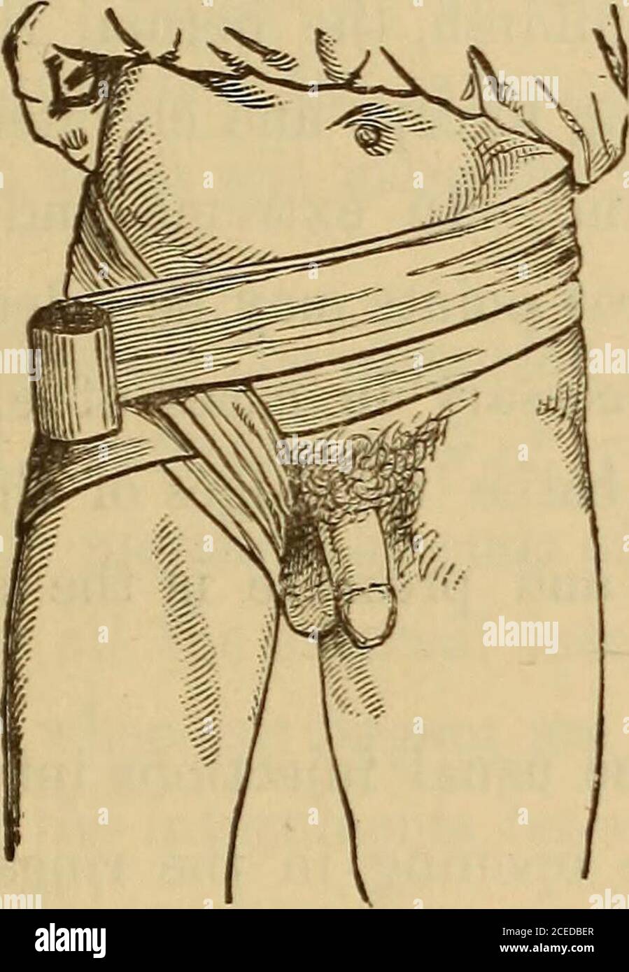 . Hernia, strangulated and reducible. With cure by subcutaneous injections, together with sugcested [!] and improved methods for kelotomy. Also an appendix giving a short account of various new surgical instruments. kened and hypertrophied fromfriction. This is formed by friction of the truss and theHernia, and forms our landmark, for its curve is peculiarand not readily mistakable in making our definition. Forsimilar operation see Heat on en Rupture. The Hernia having now been reduced and the forefingerpressed against the outer edge of the falciform process, the AUTHORS OPERATION BY INJECTION Stock Photo