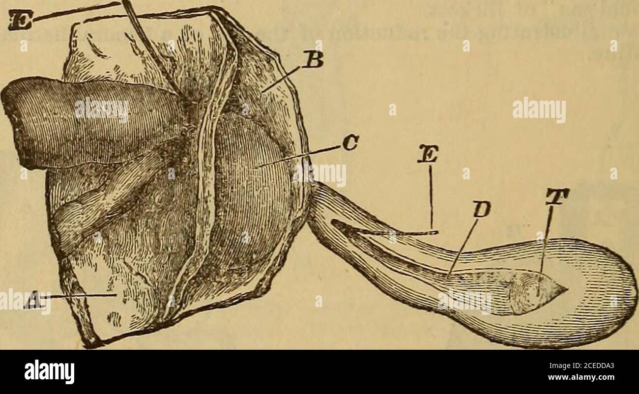 . Hernia, strangulated and reducible. With cure by subcutaneous injections, together with sugcested [!] and improved methods for kelotomy. Also an appendix giving a short account of various new surgical instruments. Testis Fig. 21.—Third variety.Interstitial hernia with ruptured neck of hernial. Fto. 22.—Drawing illustrating the fourth variety or intra-parietal form of displaced hernia. A. Peritoneum lining the abdominal muscles (B). C. Intra-parietal sac with strangulated bowel. D. Scrotal hernial sac leading down to testicle (T). E. Director passed f^om the congenital scrotal sac through the Stock Photo