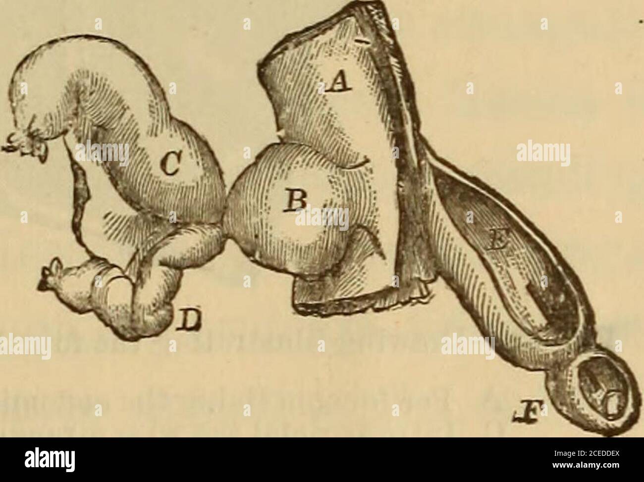 . Hernia, strangulated and reducible. With cure by subcutaneous injections, together with sugcested [!] and improved methods for kelotomy. Also an appendix giving a short account of various new surgical instruments. Fio. 19. Fio. 20. Drawing illustrating the second varieties of displaced hernia. Fig. 19. A. A portion of abdominal muscles, with the peritoneal lining. B. The strangulated fold of intestine.E. The testicle. The dark lines at the neck of the sac represent the dnplicature of the peritoneum,which being unfolded formed a sac for containing the intestine when reduced. Fig. 20. A. Perit Stock Photo