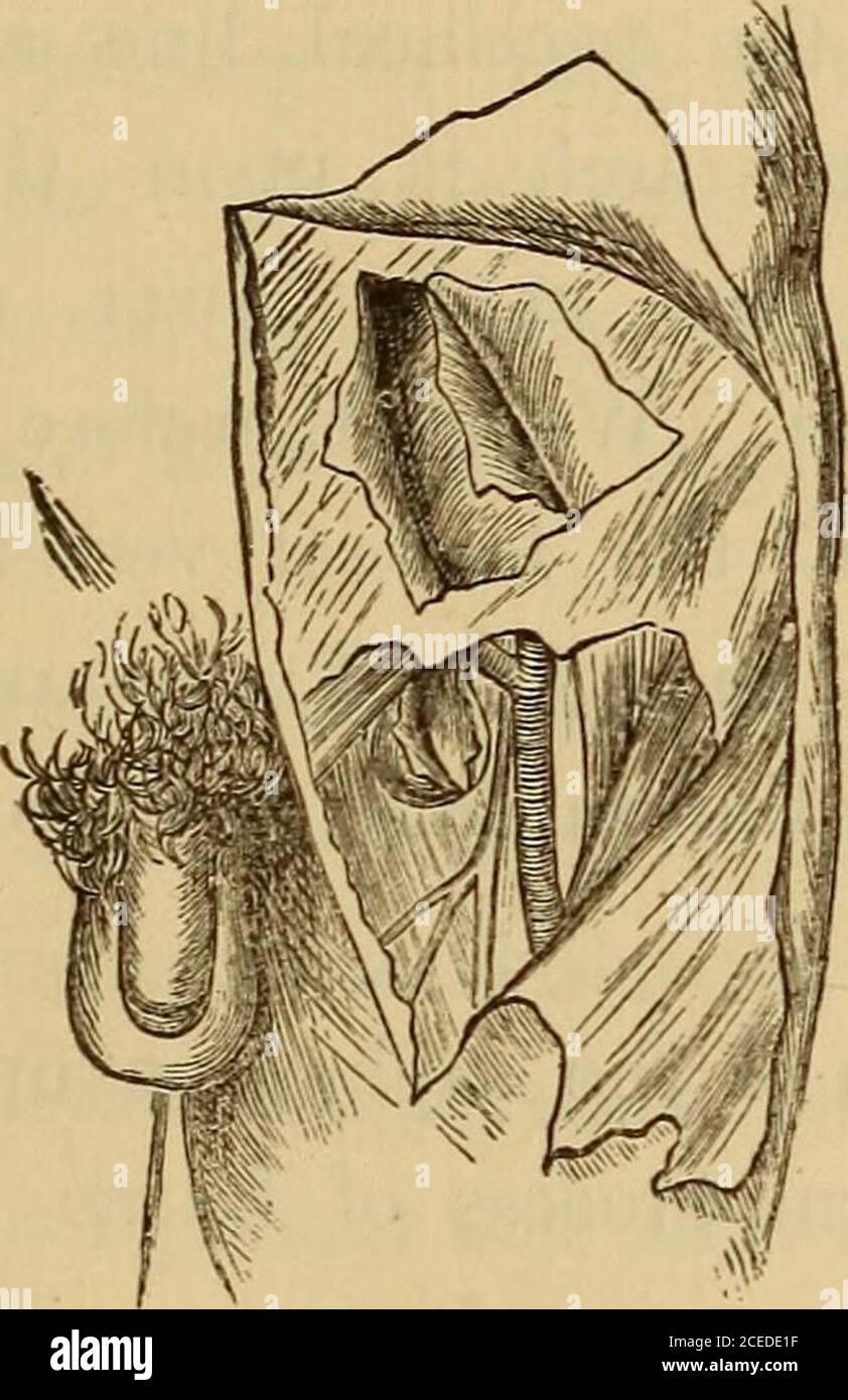 . Hernia, strangulated and reducible. With cure by subcutaneous injections, together with sugcested [!] and improved methods for kelotomy. Also an appendix giving a short account of various new surgical instruments. as in the abdominal region, betweenwhich are the cutaneous vessel and nerves and the lymphaticglands. These vessels are the internal saphenous vein andthe superficial epvjaHric, superficial circumflex iliac, and super-ficial external pubic arteries from the femoral, while thecutaneous nerves are from the ilio-in/. /nal, gcnito-crural, andanterior crural from the lumb.ir plexus. The Stock Photo