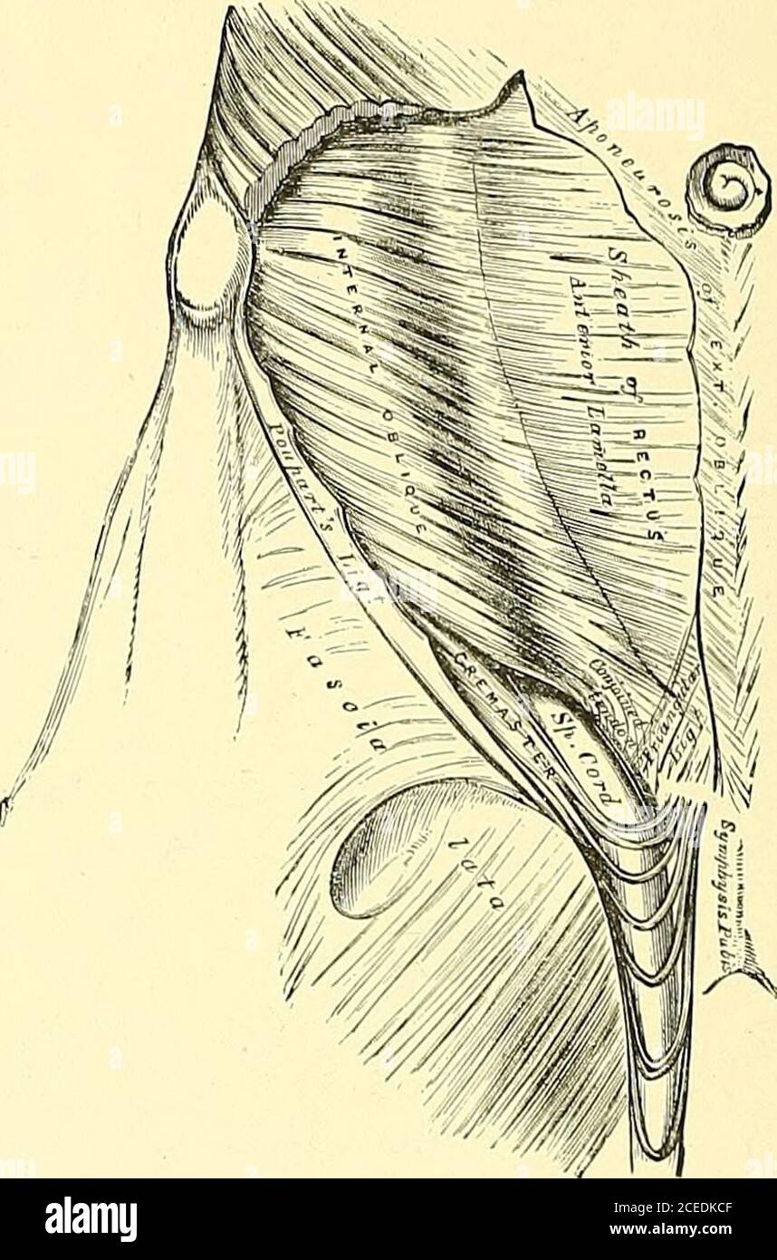. The anatomy and surgical treatment of hernia. Fig. 31. Fig. 32. Fig. 31.—Inguinal hernia, showing the transversalis fascia and the internal abdominal ring.—GRAY.Fig. 32.—Inguinal hernia, showing the internal oblique and cremaster muscles and spermatic cord.—Gray. In the dissection for the exposure of the parts, it is well to remember that thereis a superficial artery of some size—the external epigastric—which courses across theparts in the neighborhood of the external ring. This is sometimes of such a consider-able size that it misleads the inexperienced operator into the belief that the lar Stock Photo