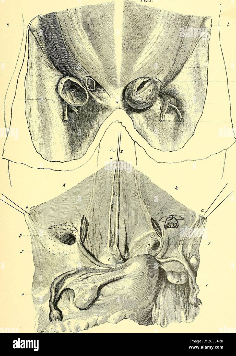 . The anatomy and surgical treatment of hernia. n for this hernia. * Verhegens reputed discovery of the difference between the seats of inguinal and femoral rupture introduceda new era in the annals of hernial surgery. Alius huic vicinus locus est, ubi fiunt herniae periculosse et ssepe lethales;scilicet, ubi vens et arteriee iliacae tendunt ad crura. Verhegen adds, adopting Parks explanation of the mode inwhich a rupture is formed, Siquidem peritonseo paululum delato, aut quod rarissime contingit, rupto, descendet exignapars intestini ilii, but proceeds in advance of his predecessor, ibidemqu Stock Photo